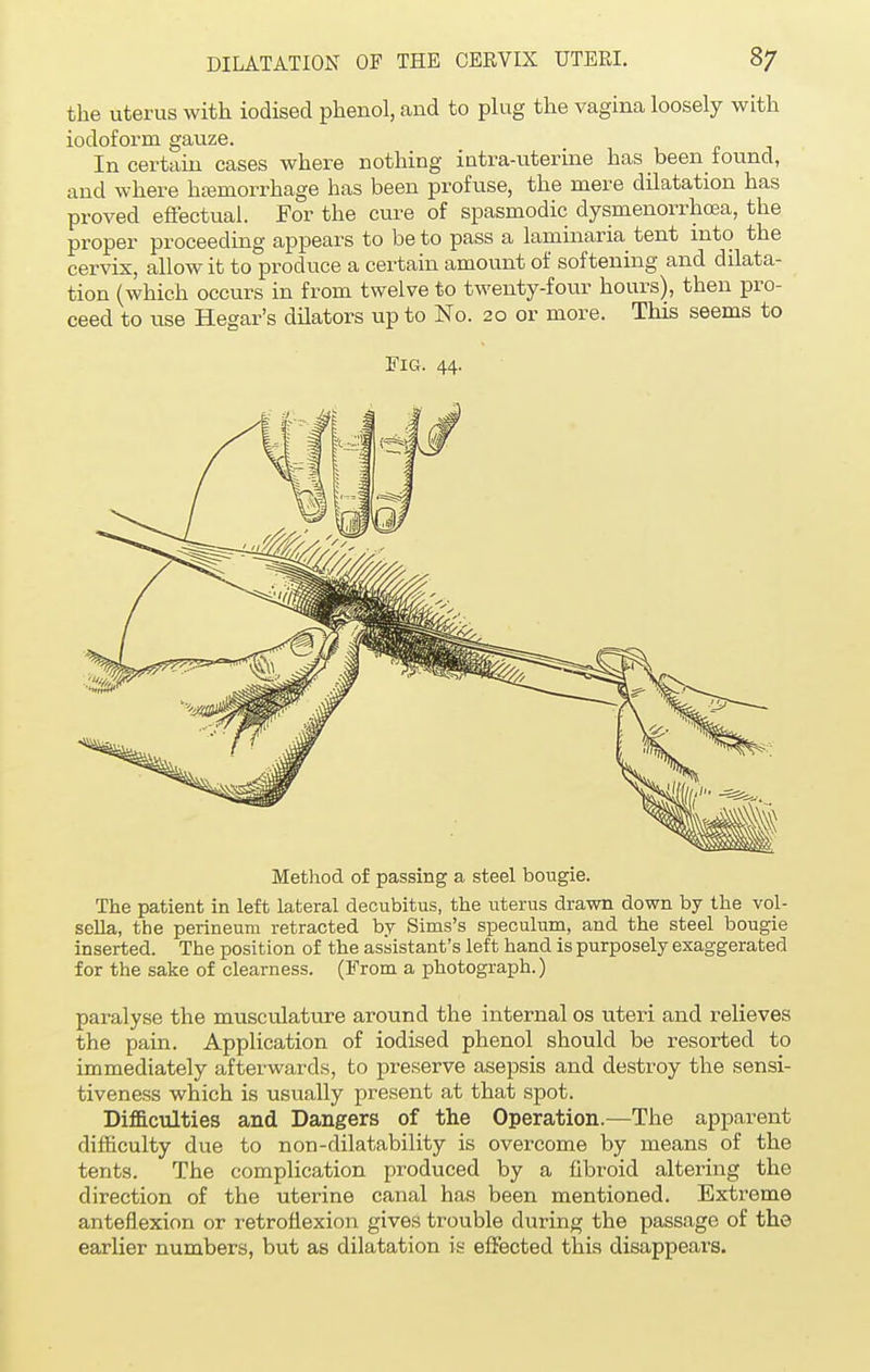 the uterus with iodised phenol, and to plug the vagina loosely with iodoform gauze. In certain cases where nothing intra-utenne has been found, and where hternorrhage has been profuse, the mere dilatation has proved effectual. For the cure of spasmodic dysmenorrhea, the proper proceeding appears to be to pass a laminaria tent into the cervix, allow it to produce a certain amount of softening and dilata- tion (which occurs in from twelve to twenty-four hours), then pro- ceed to use Hegar's dilators up to No. 20 or more. This seems to Fig. 44. Method of passing a steel bougie. The patient in left lateral decubitus, the uterus drawn down by the vol- sella, the perineum retracted by Sims's speculum, and the steel bougie inserted. The position of the assistant's left hand is purposely exaggerated for the sake of clearness. (From a photograph.) paralyse the musculature around the internal os uteri and relieves the pain. Application of iodised phenol should be resorted to immediately afterwards, to preserve asepsis and destroy the sensi- tiveness which is usually present at that spot. Difficulties and Dangers of the Operation.—The apparent difficulty due to non-dilatability is overcome by means of the tents. The complication produced by a fibroid altering the direction of the uterine canal has been mentioned. Extreme anteflexion or retroflexion gives trouble during the passage of the earlier numbers, but as dilatation is effected this disappears.