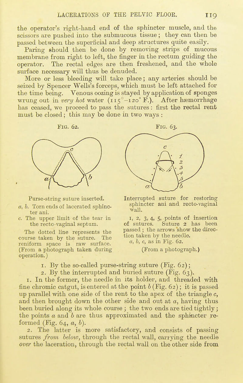 the operator's right-hand end of the sphincter muscle, and the scissors are pushed into the submucous tissue; they can then be passed between the superficial and deep structures quite easily. Paring should then be done by removing strips of mucous membrane from right to left, the finger in the rectum guiding the operator. The rectal edges are then freshened, and the whole surface necessary will thus be denuded. More or less bleeding will take place; any arteries should be seized by Spencer Wells's forceps, which must be left attached for the time being. Venous oozing is stayed by application of sponges wrung out in very hot water (ii5°-izo0 F.). After haemorrhage has ceased, we proceed to pass the sutures: first the rectal rent must be closed; this may be done in two ways : Fig. 62. Fig. 63. Interrupted suture for restoring sphincter ani and recto-vaginal wall. 1, 2, 3, 4, 5, points of insertion of sutures. Suture 2 has been passed ; the arrows show the direc- tion taken by the needle. a, b, c, as in Fig. 62. (From a photograph.) Purse-string suture inserted. a, b. Torn ends of lacerated sphinc- ter ani. c. The upper limit of the tear in the recto vaginal septum. The dotted line represents the course taken by the suture. The reniform space is raw surface. (From a photograph taken during operation.) 1. By the so-called purse-string suture (Kg. 62); 2. By the interrupted and buried suture (Fig. 63). 1. In the former, the needle in its holder, and threaded with fine chromic catgut, is entered at the point b (Fig. 62); it is passed up parallel with one side of the rent to the apex of the triangle c, and then brought down the other side and out at a, having thus been buried along its whole course ; the two ends are tied tightly; the points a and b are thus approximated and the sphincter re- formed (Fig. 64, a, b). 2. The latter is more satisfactory, and consists of passing sutures from, below, through the rectal wall, carrying the needle over the laceration, through the rectal wall on the other side from