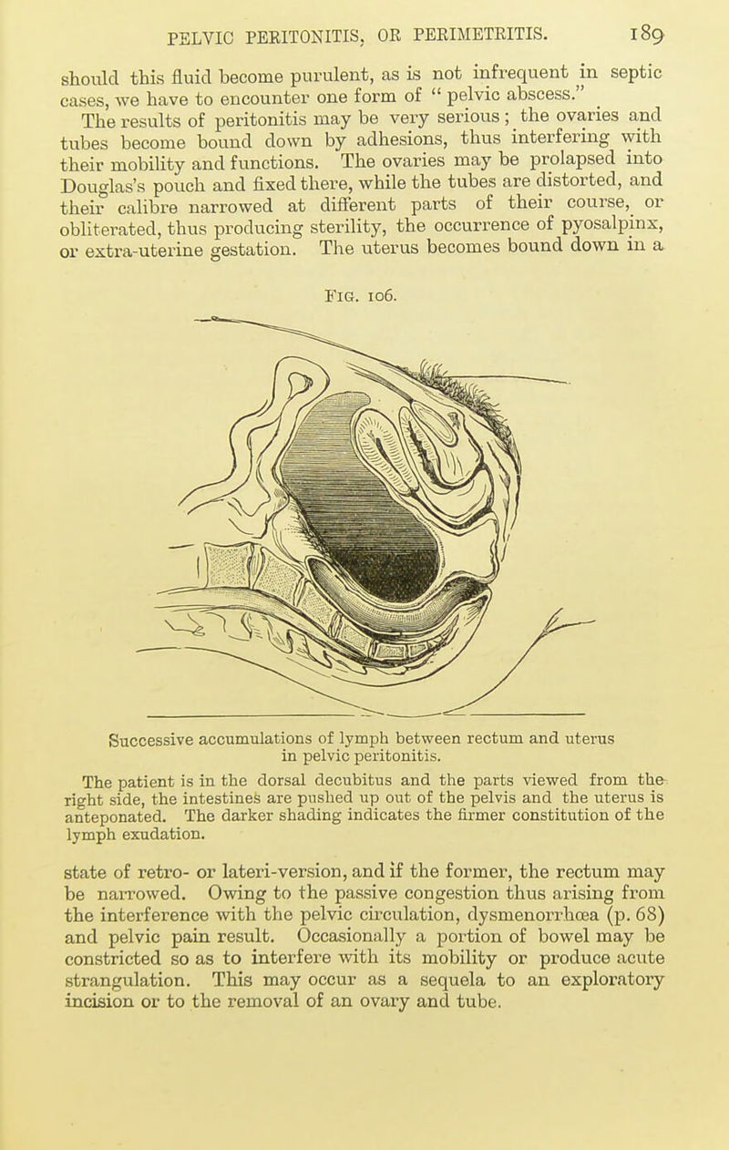 should this fluid become purulent, as is not infrequent in septic cases, we have to encounter one form of  pelvic abscess. The results of peritonitis may be very serious ; _ the ovaries and tubes become bound down by adhesions, thus interfering with their mobility and functions. The ovaries may be prolapsed into Douglas's pouch and fixed there, while the tubes are distorted, and their calibre narrowed at different parts of their course, or obliterated, thus producing sterility, the occurrence of pyosalpinx, or extra-uterine gestation. The uterus becomes bound down in a, Fig. 106. Successive accumulations of lymph between rectum and uterus in pelvic peritonitis. The patient is in the dorsal decubitus and the parts viewed from the right side, the intestines are pushed up out of the pelvis and the uterus is anteponated. The darker shading indicates the firmer constitution of the lymph exudation. state of retro- or lateri-version, and if the former, the rectum may be narrowed. Owing to the passive congestion thus arising from the interference with the pelvic circulation, dysnienorrhcea (p. 68) and pelvic pain result. Occasionally a portion of bowel may be constricted so as to interfere with its mobility or produce acute strangulation. This may occur as a sequela to an exploratory incision or to the removal of an ovary and tube.