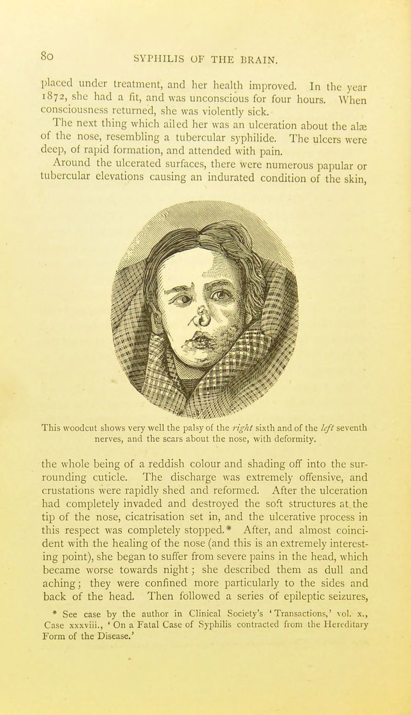 placed under treatment, and her health improved. In the year 1872, she had a fit, and was unconscious for four hours. AVhen consciousness returned, she was violently sick. The next thing which ailed her was an ulceration about the alee of the nose, resembling a tubercular syphilide. The ulcers were deep, of rapid formation, and attended with pain. Around the ulcerated surfaces, there were numerous papular or tubercular elevations causing an indurated condition of the skin, This woodcut shows very well the palsy of the right sixth and of the left seventh nerves, and the scars about the nose, with deformity. the whole being of a reddish colour and shading off into the sur- rounding cuticle. The discharge was extremely offensive, and crustations were rapidly shed and reformed. After the ulceration had completely invaded and destroyed the soft structures at the tip of the nose, cicatrisation set in, and the ulcerative process in this respect was completely stopped.* After, and almost coinci- dent with the healing of the nose (and this is an extremely interest- ing point), she began to suffer from severe pains in the head, which became worse towards night; she described them as dull and aching; they were confined more particularly to the sides and back of the head. Then followed a series of epileptic seizures, * See case by the author in Clinical Society's 'Transactions,' \o]. x., Case xxxviii., ' On a Fatal Case of Syphilis contracted from the Hereditary Form of the Disease.'