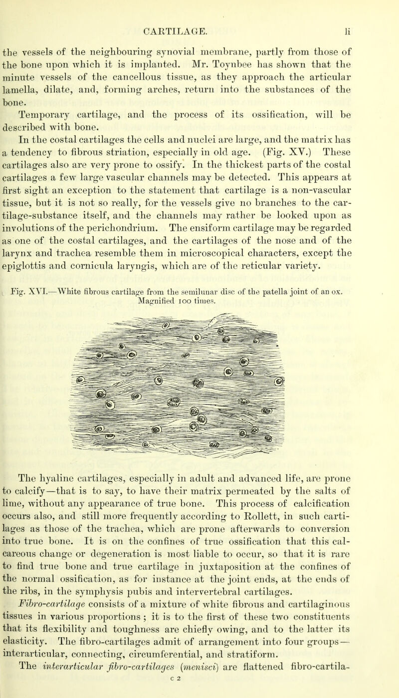 the vessels of the neighbouring synovial membrane, partly from those of the bone upon which it is implanted. Mr. Toynbee has shown that the minute vessels of the cancellous tissue, as they approach the articular lamella, dilate, and, forming arches, return into the substances of the bone. Temporary cartilage, and the process of its ossification, will be described with bone. In the costal cartilages the cells and nuclei are large, and the matrix has a tendency to fibrous striation, especially in old age. (Fig. XV.) These cartilages also are very prone to ossify. In the thickest parts of the costal cartilages a few large vascular channels may be detected. This appears at first sight an exception to the statement that cartilage is a non-vascular tissue, but it is not so really, for the vessels give no branches to the car- tilage-substance itself, and the channels may rather be looked upon as involutions of the perichondrium. The ensiform cartilage may be regarded as one of the costal cartilages, and the cartilages of the nose and of the larynx and trachea resemble them in microscopical characters, except the epiglottis and cornicula laryngis, which are of the reticular variety. Fig. XVI.—White fibrous cartilage from the semilunar disc of the patella joint of an ox. Magnified 100 times. The hyaline cartilages, especially in adult and advanced life, are prone to calcify—that is to say, to have their matrix permeated by the salts of lime, without any appearance of true bone. This process of calcification occurs also, and still more frequently according to Rollett, in such carti- lages as those of the trachea, which are prone afterwards to conversion into true bone. It is on the confines of true ossification that this cal- careous change or degeneration is most liable to occur, so that it is rare to find true bone and true cartilage in juxtaposition at the confines of the normal ossification, as for instance at the joint ends, at the ends of the ribs, in the symphysis pubis and intervertebral cartilages. Fibro-cartilage consists of a mixture of white fibrous and cartilaginous tissues in various proportions ; it is to the first of these two constituents that its flexibility and toughness are chiefly owing, and to the latter its elasticity. The fibro-cartilages admit of arrangement into four groups — interarticular, connecting, circumferential, and stratiform. The interarticular fibro-cartilages (menisci) are flattened fibro-cartila- C 2