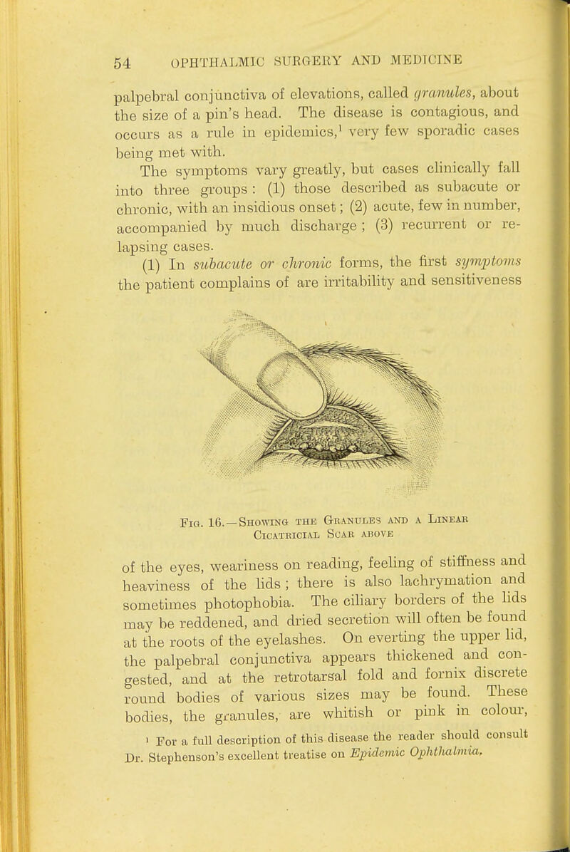 palpebral conjunctiva of elevations, called granules, about the size of a pin's head. The disease is contagious, and occurs as a rule in epidemics,' very few sporadic cases being met with. The symptoms vary greatly, but cases clinically fall into three groups : (1) those described as sul^acute or chronic, with an insidious onset; (2) acute, few in number, accompanied by much discharge ; (3) recurrent or re- lapsing cases. (1) In subacute or chronic forms, the first symptoms the patient complains of are irritability and sensitiveness Fig. 16. —Showing the Granules and a Lineae CiCATKiciAL Suae above of the eyes, weariness on reading, feehng of stiffness and heaviness of the hds ; there is also lachrymation and sometimes photophobia. The cihary borders of the hds may be reddened, and dried secretion will often be found at the roots of the eyelashes. On everting the upper lid, the palpebral conjunctiva appears thickened and con- gested, and at the retrotarsal fold and fornix discrete round bodies of various sizes may be found. These bodies, the granules, are whitish or pink m colour, > For a full description of this disease the reader should consult Dr. Stephenson's exceUent treatise on Epidemic OphtMlmia,