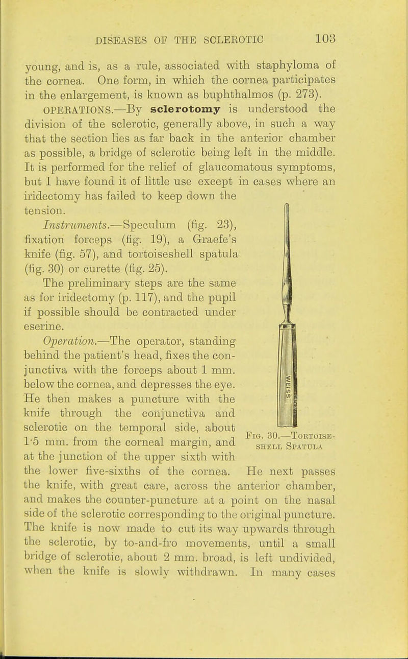 young, and is, as a rule, associated with staphyloma of the cornea. One form, in which the cornea participates in the enlargement, is known as buphthalmos (p. 273). OPERATIONS.—By sclerotomy is understood the division of the sclerotic, generally above, in such a way that the section lies as far back in the anterior chamber as possible, a bridge of sclerotic being left in the middle. It is performed for the relief of glaucomatous symptoms, but I have found it of little use except in cases where an iridectomy has failed to keep down the tension. I Instruments.—Speculum (fig. 23), l fixation forceps (tig. 19), a Graefe's knife (fig. 57), and tortoiseshell spatula i (fig. 30) or curette (fig. 25). , The prehminary steps are the same r as for iridectomy (p. 117), and the pupil if possible should be contracted under eserine. Operation.—The operator, standing behind the patient's head, fixes the con- junctiva with the forceps about 1 mm. below the cornea, and depresses the eye. He then makes a puncture with the knife through the conjunctiva and sclerotic on the temporal side, about 1 c I! 1 • n Fig. 30.—Toktoise- I'O mm. from the corneal margin, and shell Spatul.\ at the junction of the upper sixth with the lower five-sixths of the cornea. He next passes the knife, with great care, across the anterior chamber, and makes the counter-puncture at a point on the nasal side of the sclerotic corresponding to the original puncture. The knife is now made to cut its way upwards through the sclerotic, by to-and-fro movements, until a small bridge of sclerotic, about 2 mm. broad, is left undivided, when the knife is slowly witlidrawn. In many cases