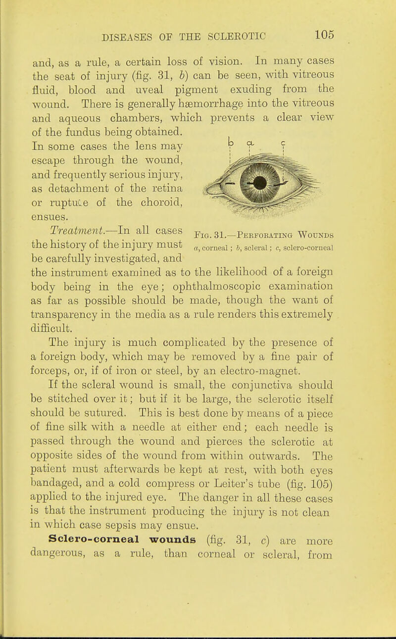 and, as a rule, a certain loss of vision. In many cases the seat of injury (fig. 31, h) can be seen, with vitreous fluid, blood and uveal pigment exuding from the wound. There is generally hgemorrhage into the vitreous and aqueous chambers, which prevents a clear view of the fundus being obtained. In some cases the lens ixiay escape through the wound, and frequently serious injury, as detachment of the retina or ruptuiLe of the choroid, ensues. Treatment—In all cases pi^j. 3i._pebfoeating Wounds the history of the injury must .o^neal; h, scleral; c, sclero-oorneal be carefully investigated, and the instrument examined as to the likelihood of a foreign body being in the eye; ophthalmoscopic examination as far as possible should be made, though the want of transparency in the media as a rule renders this extremely difficult. The injury is much complicated by the presence of a foreign body, which may be removed by a fine pair of forceps, or, if of iron or steel, by an electro-magnet. If the scleral wound is small, the conjunctiva should be stitched over it; but if it be large, the sclerotic itself should be sutured. This is best done by means of a piece of fine silk with a needle at either end; each needle is passed through the wound and pierces the sclerotic at opposite sides of the wound from within outwards. The patient must afterwards be kept at rest, with both eyes bandaged, and a cold compress or Leiter's tube (fig. 105) applied to the injured eye. The danger in all these cases is that the instrument producing the injury is not clean in which case sepsis may ensue. Sclero-corneal wounds (fig. 31, c) are more dangerous, as a rule, than corneal or scleral, from