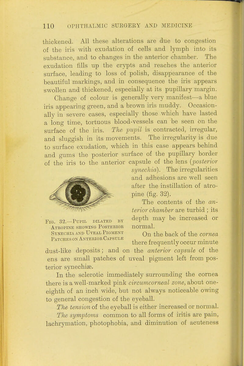 thickened. All these alterations are due to congestion of the iris with exudation of cells and lymph into its substance, and to changes in the anterior chamber. The exudation fills up the crypts and reaches the anterior surface, leading to loss of polish, disappearance of the beautiful markings, and in consequence the iris appears swollen and thickened, especially at its pupillary margin. Change of colour is generally very manifest—a blue iris appearing green, and a brown iris muddy. Occasion- ally in severe cases, especially those which have lasted a long time, tortuous blood-vessels can be seen on the surface of the iris. The pupil is contracted, irregular, and sluggish in its movements. The irregularity is due to surface exudation, which in this case appears behind and gums the posterior surface of the pupillary border of the iris to the anterior capsule of the lens {jjosterior synechia). The irregularities and adhesions are well seen after the instillation of atro- pine (fig. 32). The contents of the an- terior chamber are turbid ; its depth may be increased or normal. On the back of the cornea there frequently occur minute dust-like deposits; and on the anterior cajmile of the ens are small patches of uveal pigment left from pos- terior synechias. In the sclerotic immediately surrounding the cornea there is a well-marked pink circumcorneal zone, about one- eighth of an inch wide, but not always noticeable owing to general congestion of the eyeball. The tension of the eyeball is either increased or normal. The symptoms common to all forms of iritis are pain, lachrymation, photophobia, and diminution of acuteness Fig. 32.—Pupil dilated by Atropine showing Postemob SyNECHIA AND UvEAL PIGMENT Patches on Anteriob Capsule