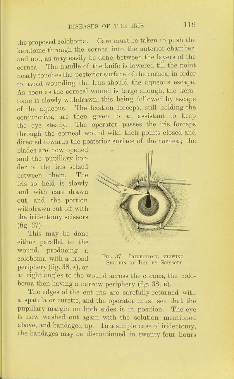 the proposed coloboma. Care must be taken to push the keratome through the cornea into the anterior chamber, and not, as may easily be done, between the layers of the cornea. The handle of the knife is lowered till the point nearly touches the posterior surface of the cornea, in order to avoid wounding the lens should the aqueous escape. As soon as the corneal wound is large enough, the kera- tome is slowly withdrawn, this being followed by escape of the aqueous. The fixation forceps, still holding the conjunctiva, are then given to an assistant to keep the eye steady. The operator passes the iris forceps through the corneal wound with their points closed and directed towards the posterior sm-face of the cornea ; the blades are now opened and the pupillary bor- der of the iris seized between them. The iris so held is slowly and with care drawn out, and the portion withdrawn cut off with the iridectomy scissors (fig. 37). This may be done either parallel to the wound, producing a coloboma with a broad periphery (fig. 38, a), or at right angles to the wound across the cornea, the colo- boma then having a narrow periphery (fig. 38, b). The edges of the cut iris are carefully returned with a spatula or curette, and the operator must see that the pupillary margin on both sides is in position. The eye is now washed out again with the solution mentioned above, and bandaged up. In a simple case of iridectomy, the bandages may be discontinued in twenty-four hours Fig. 37.—Iridectomy, showing Section of Ieis by Scissoes