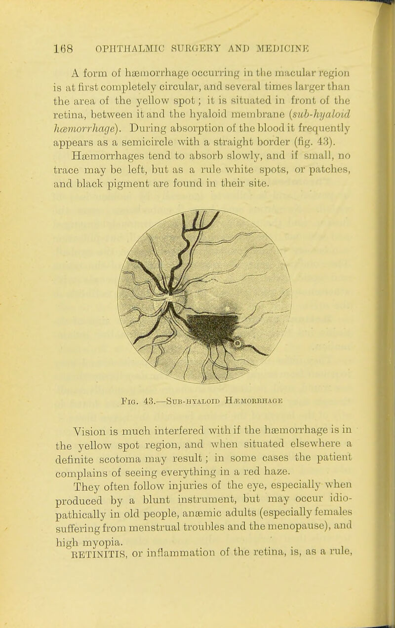 A form of hiBiiiorrhage occurring in the macular region is at first completely circular, and several times larger than the area of the yellow spot; it is situated in front of the retina, between it and the hyaloid membrane {suh-hyaloid hcsmorrhage). During absorption of the blood it frequently appears as a semicircle with a straight border (fig. 43). Haemorrhages tend to absorb slowly, and if small, no trace may be left, but as a rule white spots, or patches, and black pigment are found in their site. Fig. 43.—Sub-uyaloid Hzhmokbhage Vision is much interfered with if the haemorrhage is in the yellow spot region, and when situated elsewhere a definite scotoma may result; in some cases the patient complains of seeing everything in a red haze. They often follow injuries of the eye, especially when produced by a blunt instrument, but may occur idio- pathically in old people, anaemic adults (especially females suffering from menstrual troubles and the menopause), and high myopia. RETINITIS, or inflammation of the retina, is, as a rule.