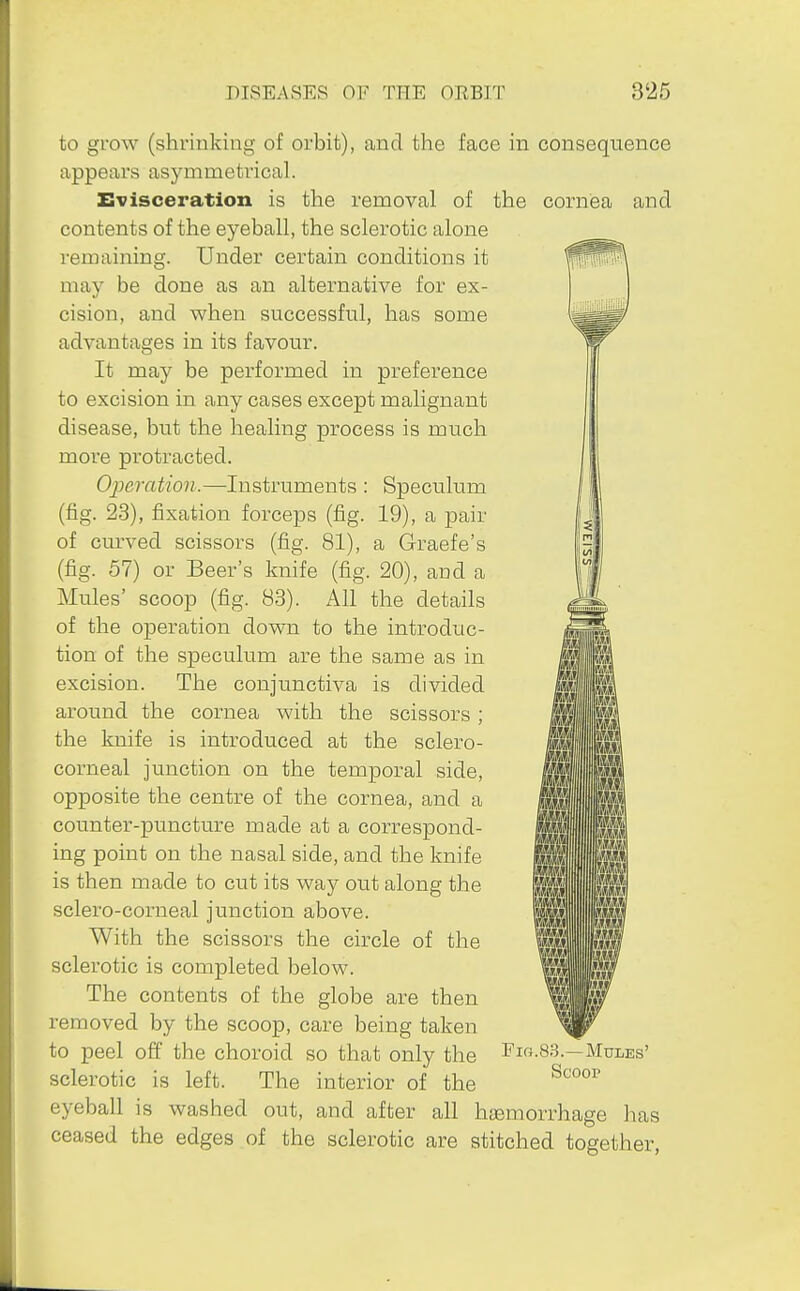 to grow (shrinking of orbit), and the face in consequence appears asymmetrical. Evisceration is the removal of the cornea and contents of the eyeball, the sclerotic alone remaining. Under certain conditions it may be done as an alternative for ex- cision, and when successful, has some advantages in its favour. It may be performed in preference to excision in any cases except malignant disease, but the healing process is much more protracted. Operation.—Instruments : Speculum (fig. 23), fixation forceps (fig. 19), a pair of curved scissors (fig. 81), a Graefe's (fig. 57) or Beer's knife (fig. 20), and a Mules' scoop (fig. 83). All the details of the operation down to the introduc- tion of the speculum are the same as in ? excision. The conjunctiva is divided \ around the cornea with the scissors ; the knife is introduced at the sclero- corneal junction on the temporal side, opposite the centre of the cornea, and a counter-puncture made at a correspond- ing point on the nasal side, and the knife is then made to cut its way out along the sclero-corneal junction above. With the scissors the circle of the sclerotic is completed below. The contents of the globe are then removed by the scoop, care being taken to peel off the choroid so that only the Mules' sclerotic is left. The interior of the eyeball is washed out, and after all haemorrhage has ceased the edges of the sclerotic are stitched together,
