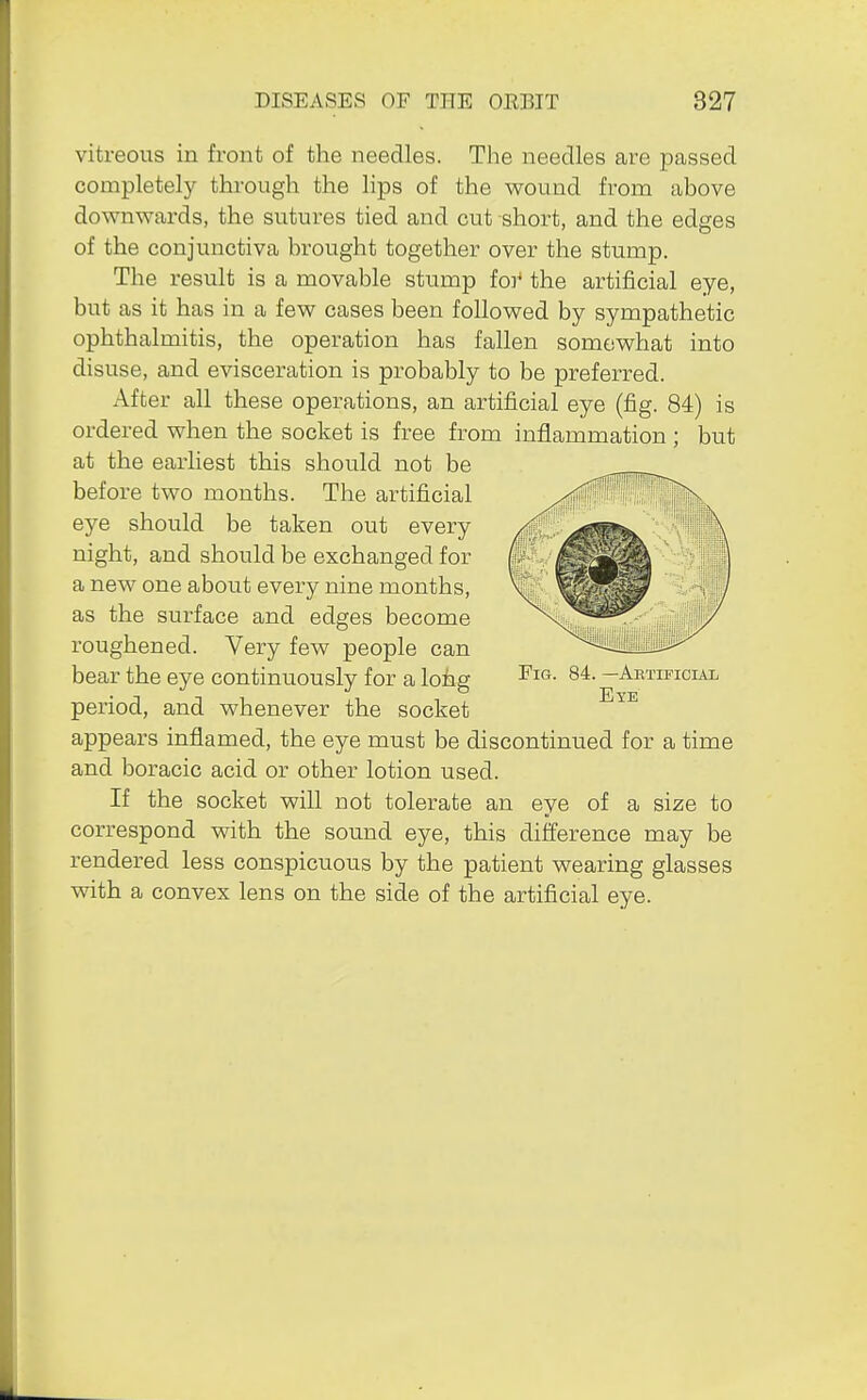 vitreous in front of the needles. The needles are passed completely through the lips of the wound from above downwards, the sutures tied and cut short, and the edges of the conjunctiva brought together over the stump. The result is a movable stump foi the artificial eye, but as it has in a few cases been followed by sympathetic ophthalmitis, the operation has fallen somewhat into disuse, and evisceration is probably to be preferred. After all these operations, an artificial eye (fig. 84) is ordered when the socket is free from inflammation ; but at the earliest this should not be before two months. The artificial ^^f^S™!!!' eye should be taken out every night, and should be exchanged for a new one about every nine months, as the surface and edges become roughened. Very few people can bear the eye continuously for a long ^4. -AETinciAi period, and whenever the socket appears inflamed, the eye must be discontinued for a time and boracic acid or other lotion used. If the socket will not tolerate an eye of a size to correspond with the sound eye, this difference may be rendered less conspicuous by the patient wearing glasses with a convex lens on the side of the artificial eye.