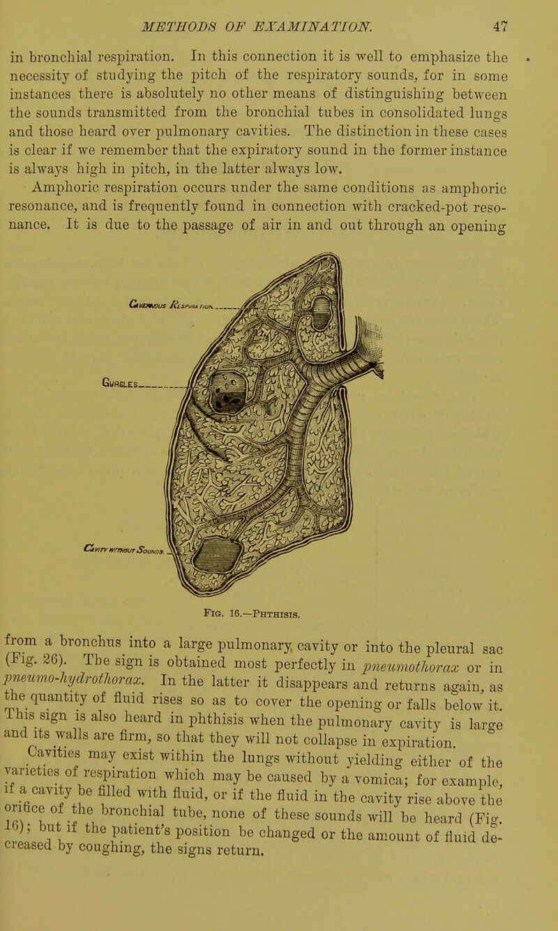 in bronchial respiration. In this connection it is well to emphasize the necessity of studying the j)itch of the respiratory sounds, for in some instances there is absolutely no other means of distinguishing between the sounds transmitted from the bronchial tubes in consolidated lungs and those heard over pulmonary cavities. The distinction in these cases is clear if we remember that the expiratory sound in the former instance is always high in pitch, in the latter always low. Amphoric respiration occurs under the same conditions as amphoric resonance, and is frequently found in connection with cracked-pot reso- nance. It is due to the passage of air in and out through an opening Gurgles Gf/n' wmmurSoums. Fig. 16.—Phthisis. from a bronchus into a large pulmonary cavity or into the pleural sac (Fig. 26). The sign is obtained most perfectly in pneumotliorax or in pnmmo-MjdrothoTax. In the latter it disappears and returns again, as the quantity of fluid rises so as to cover the opening or falls below it. i his sign IS also heard in phthisis when the pulmonary cavity is large and Its walls are firm, so that they will not collapse in expiration Cavities may exist within the lungs without yielding either of the varieties of respiration which may be caused by a vomica; for example. If .a cavity be filled with fluid, or if the fluid in the cavity rise above the 1 ^'^'^^ '^^^ °^ ^^^^^ be heard (Fig. lb); but If the patient's position be changed or the amount of fluid de- creased by coughing, the signs return.