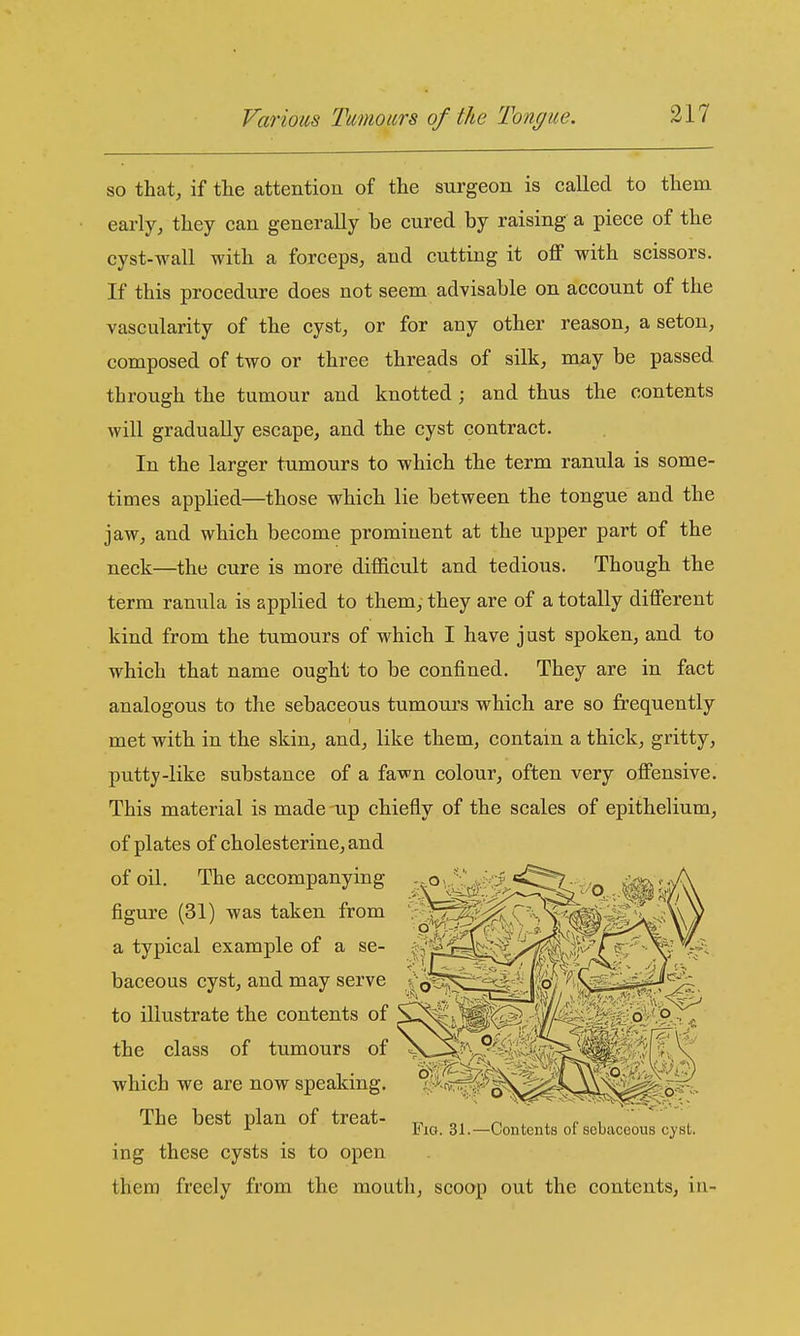 so that, if the attention of the surgeon is called to them early, they can generally be cured by raising a piece of the cyst-wall with a forceps, and cutting it off with scissors. If this procedure does not seem advisable on account of the vascularity of the cyst, or for any other reason, a seton, composed of two or three threads of silk, may be passed through the tumour and knotted ; and thus the contents will gradually escape, and the cyst contract. In the larger tumours to which the term ranula is some- times applied—those which lie between the tongue and the jaw, and which become prominent at the upper part of the neck—the cure is more difficult and tedious. Though the term ranula is applied to them, they are of a totally different kind from the tumours of which I have just spoken, and to which that name ought to be confined. They are in fact analogous to the sebaceous tumours which are so frequently met with in the skin, and, like them, contain a thick, gritty, putty-like substance of a fawn colour, often very offensive. This material is made up chiefly of the scales of epithelium, of plates of cholesterine,and of oil. The accompanying figure (31) was taken from a typical example of a se- baceous cyst, and may serve to illustrate the contents of the class of tumours of which we are now speaking. The best plan of treat- ing these cysts is to open them freely from the mouth, scoop out the contents, in- Fia. 31.—Contents of sebaceous cyst.