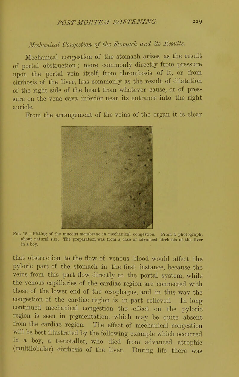 Mechanical Congestion of the Stomach and its Results. Mechanical congestion of the stomach arises as the result of portal obstruction; more commonly directly from pressure upon the portal vein itself, from thrombosis of it, or from cirrhosis of the liver, less commonly as the result of dilatation of the right side of the heart from whatever cause, or of pres- sure on the vena cava inferior near its entrance into the right auricle. From the arrangement of the veins of the organ it is clear Fig. 18.—Pitting of the mucous membrane in meoiianical congestion. From a photograph, about natural size. The preparation was from a case of advanced cirrhosis of the liver in a boy. that obstruction to the flow of venous blood would affect the pyloric part of the stomach in the first instance, because the veins from this part flow directly to the portal system, while the venous capillaries of the cardiac region are connected with those of the lower end of the oesophagus, and in this way the congestion of the cardiac region is in part relieved. In long continued mechanical congestion the effect on the pyloric region is seen in pigmentation, which may be quite absent from the cardiac region. The effect of mechanical congestion will be best illustrated by the following example which occurred m a boy, a teetotaller, who died from advanced atrophic (multilobular) cirrhosis of the liver. During life there was