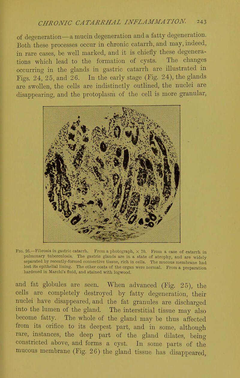 of degeneration—a mucin degeneration and a fatty degeneration. Both these processes occur in chronic catarrh, and may, indeed, in rare cases, be well marked, and it is chiefly these degenera- tions which lead to the formation of cysts. The changes occurring in the glands in gastric catarrh are illustrated in Figs. 24, 25, and 26. In the early stage (Fig. 24), the glands are swollen, the cells are indistinctly outlined, the nuclei are disappearing, and the protoplasm of the cell is more granular. pulmonary tuberculosis. The gastric glautls are in a state of atrophy, and are widely separated by recently-formed connective tissue, rich in cells. The mucous membrane had lost its epithelial lining. The other coats of the organ were normal. From a preparation hardened in Marchi's fluid, and stained with logwood. and fat globules are seen. When advanced (Fig. 25), the cells are completely destroyed by fatty degeneration, their nuclei have disappeared, and the fat granules are discharged into the lumen of the gland. The interstitial tissue may also become fatty. The whole of the gland may be thus affected from its orifice to its deepest part, and in some, although rare, instances, the deep part of the gland dilates, being constricted above, and forms a cyst. In some parts of the mucous membrane (Fig. 26) the gland tissue lias disappeared,