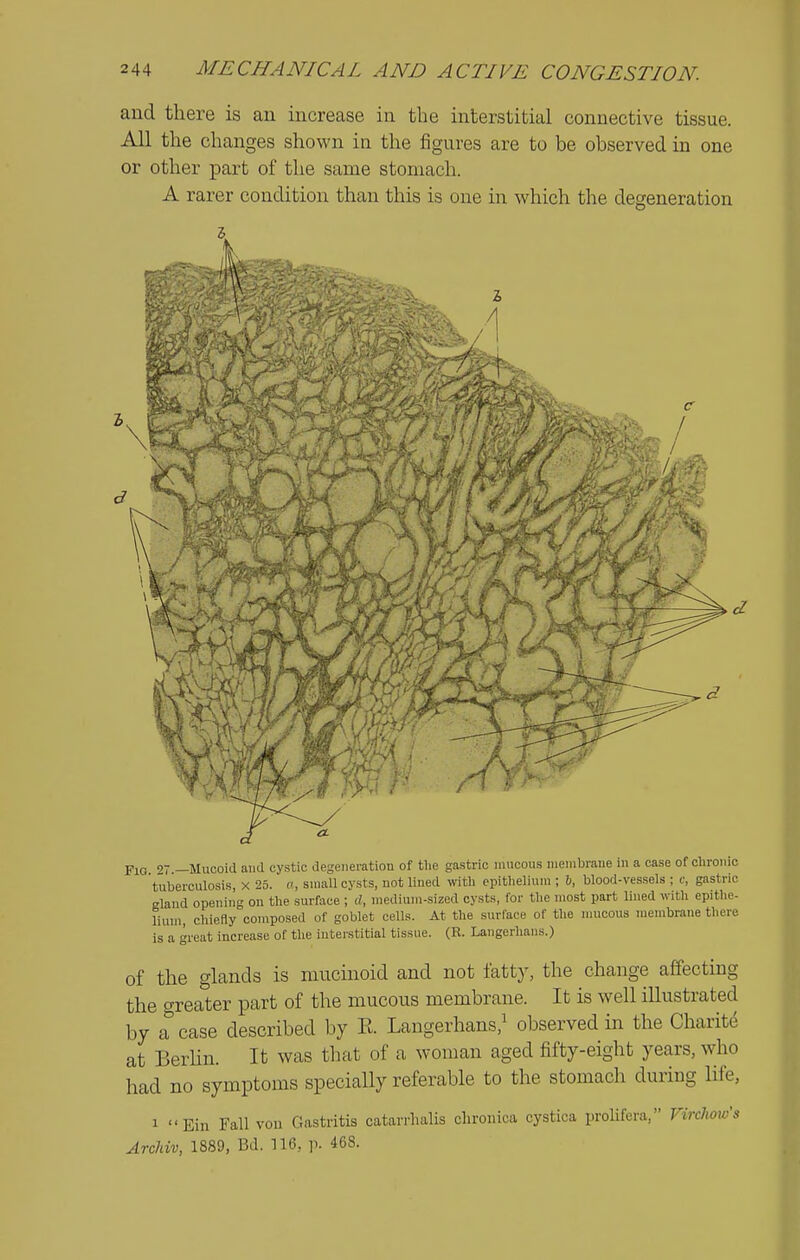 and there is an increase in the interstitial connective tissue. All the changes shown in the figures are to be observed in one or other part of the same stomach. A rarer condition than this is one in which the degeneration FiQ 97 —Mucoid and cystic degeneration of the gastric mucous nieiiibraiie in a case of chronic tuberculosis, x 25. f , small cysts, not lined with epitlieliuni ; 6, blood-vessels ; c, gastric Eland opening on the surface ; d, medium-sized cysts, for the most part lined with epithe- lium, chiefly composed of goblet cells. At the surface of the nuicous membrane there is a <'reat increase of the interstitial tissue. (R. Langerhaus.) of the glands is mucinoid and not fatt}', the change affecting the greater part of the mucous membrane. It is well illustrated by a case described by E. Langerhans,^ observed in the Charitd at Berhn. It was tliat of a woman aged fifty-eight years, who had no symptoms speciaUy referable to the stomach during life, 1 Ein Fall von Gastritis catarrhalis chronica cystica prolifera, Virchoxo's Archiv, 1889, Bd. 116, p. 468.