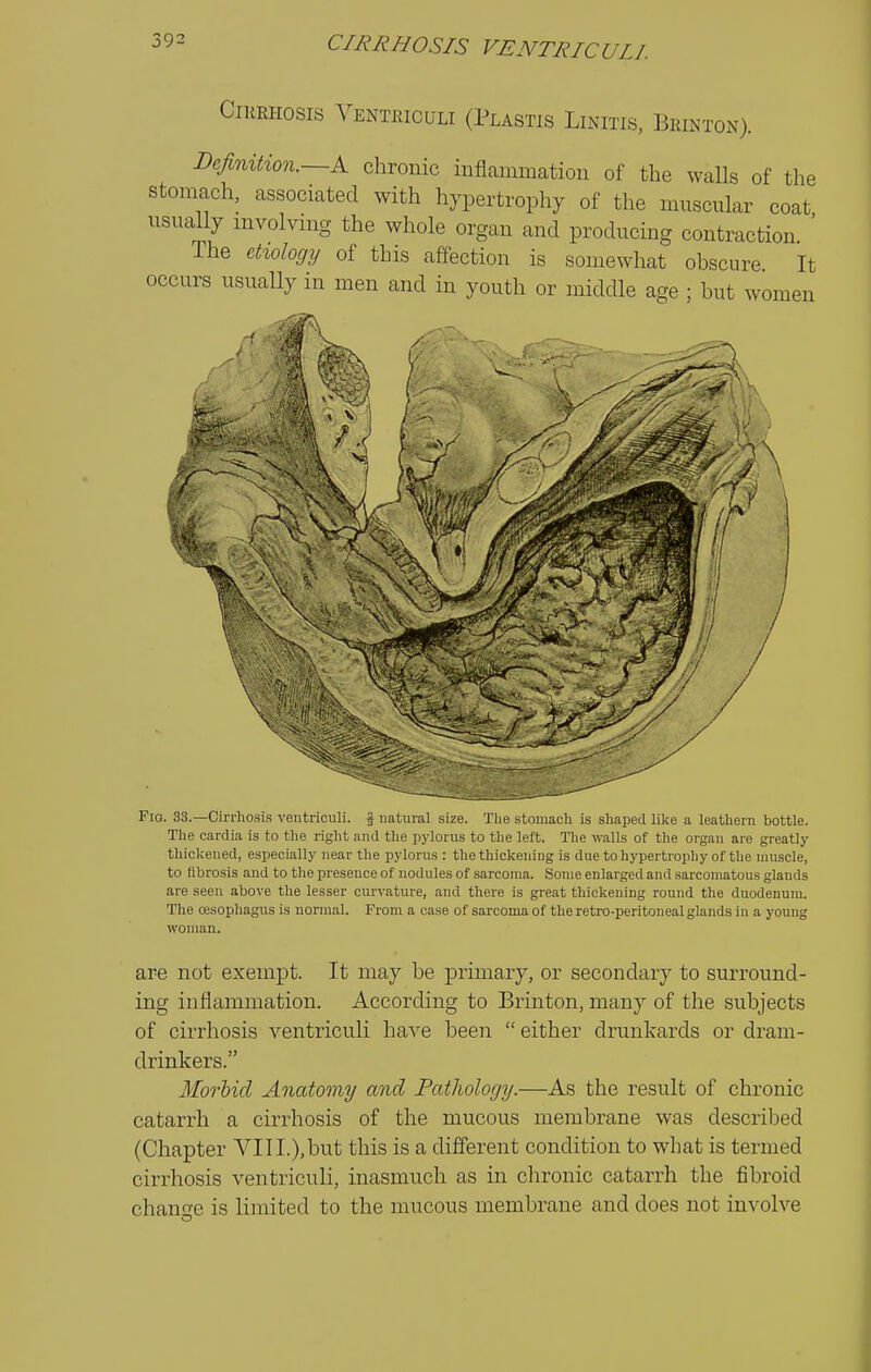 ClKEHOSIS YENTIilCULI (PlASTIS LiNITIS, BrINTON). Definition.—K chronic inflammatiou of the walls of the stomach, associated with hypertrophy of the muscular coat usuaUy mvolvmg the whole organ and producing contraction ' The et%ology of this affection is somewhat obscure It occurs usually in men and in youth or middle age ; but women Fio. 33.—Cirrhosis ventriculi. J natural size. Tlie stomach is shaped like a leathern bottle. The cardia is to the right and the pylorus to the left. The walls of the organ are greatly thickened, especially near the pylorus : the thickening is due to hypertrojihy of the muscle, to fibrosis and to the presence of nodules of sarcoma. Some enlarged and sarcomatous glands are seen above the lesser curvature, and there is gi'eat thickening round the duodenum. The oesophagus is normal. From a case of sarcoma of the retro-peritoneal glands in a young woman. are not exempt. It may be primary, or secondary to surround- ing inflammation. According to Brinton, many of the subjects of cirrhosis ventriculi have been  either drunkards or dram- drinkers. Morhicl Anatomy and Pathology.—As the result of chronic catarrh a cirrhosis of the mucous membrane was described (Chapter VIII.),but this is a different condition to what is termed cirrhosis ventriculi, inasmuch as in chronic catarrh the fibroid chanfe is limited to the mucous membrane and does not involve