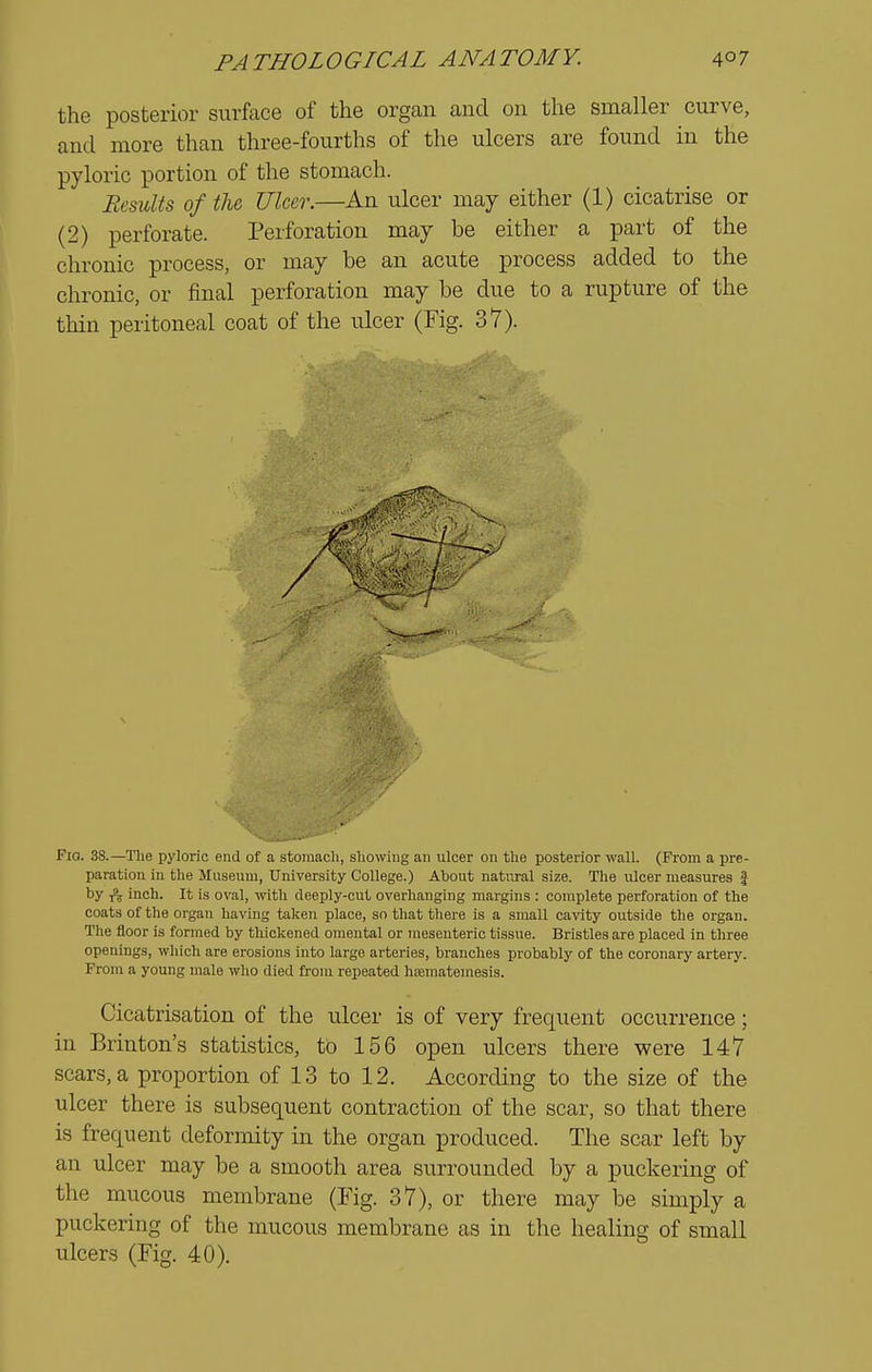 the posterior surface of the organ and on the smaller curve, and more than three-fourths of the ulcers are found in the pyloric portion of the stomach. Ecmlts of the Ulcer.—An ulcer may either (1) cicatrise or (2) perforate. Perforation may be either a part of the chronic process, or may be an acute process added to the chronic, or final perforation may be due to a rupture of the thin peritoneal coat of the ulcer (Fig. 37). Fio. 38.—The pyloric end of a stomach, showing an ulcer on the posterior wall. (From a pre- paration in the Museum, University College.) About natural size. The ulcer measures f by inch. It is oval, ^vith deeply-cut overhanging margins : complete perforation of the coats of the organ having talcen place, so that there is a small cavity outside the organ. The floor is formed by thickened omental or mesenteric tissue. Bristles are placed in three openings, which are erosions into large arteries, branches probably of the coronary artery. From a young male who died from repeated hfemateniesis. Cicatrisation of the ulcer is of very frequent occurrence; in Brinton's statistics, to 156 open ulcers there were 147 scars, a proportion of 13 to 12. According to the size of the ulcer there is subsequent contraction of the scar, so that there is frequent deformity in the organ produced. The scar left by an ulcer may be a smooth area surrounded by a puckering of the mucous membrane (Fig. 37), or there may be simply a puckering of the mucous membrane as in the healing of small ulcers (Fig. 40).