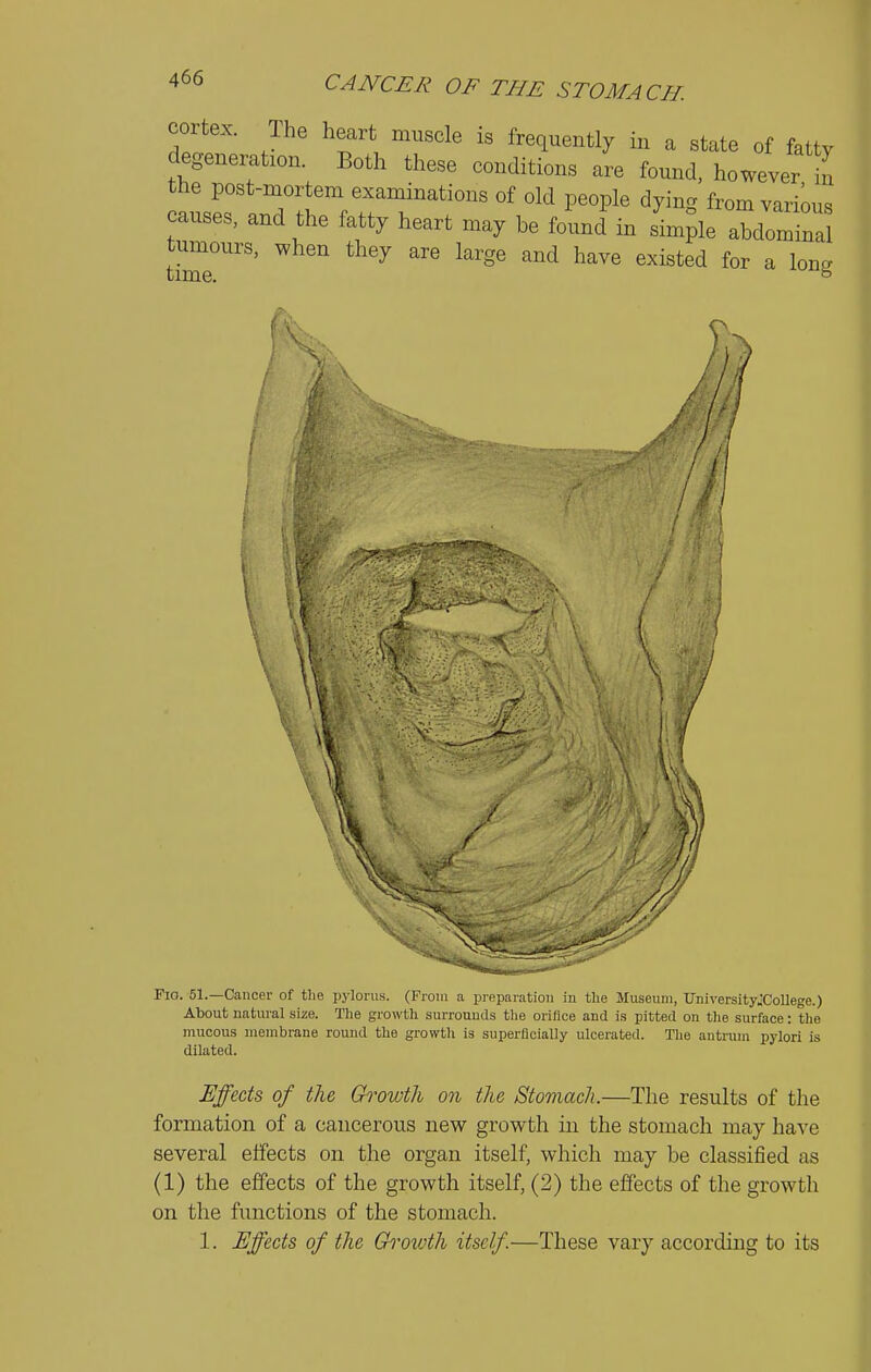 cortex. Ihe heart muscle is frequently in a state of fatty degeneration. Both these conditions are found, however in the post-mortem examinations of old people dying from various causes, and the fatty heart may be found' in s'im;ie tumours, when they are large and have existed for a Ion. time. ^ * /1 Fio. 51.—Cancer of tlie pylorus. (From a preparation in the Museum, tlniversityXoUege.) About natural size. The growth surrounds the orifice and is pitted on the surface: the mucous membrane round the growth is superficially ulcerated. The antrum pylori is dilated. Effects of the Growth on the Stomach.—The results of the formation of a cancerous new growth in the stomach may have several effects on the organ itself, which may be classified as (1) the effects of the growth itself, (2) the effects of the growth on the functions of the stomach. 1. Effects of the Gh^owth itself.—These vary according to its