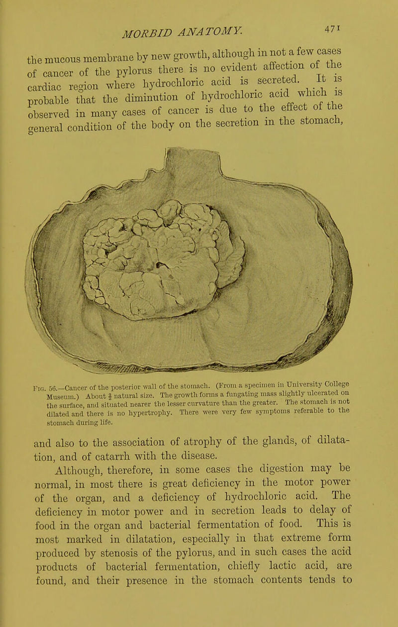 the mucous membrane by new growth, although m not a few cases of cancer of the pylorus there is no evident affection of the cardiac region where hydrochloric acid is secreted. It is probable that the diminution of hydrochloric acid which is observed in many cases of cancer is due to the effect of the ceneral condition of the body on the secretion m the stomach, Fig 56 -Cancer of the posterior wall of the stomach. (From a specimen in University CoUege Museum.) About f natural size. The growth forms a fungating mass slightly ulcerated on the surface, and situated nearer the lesser curvature than the greater. The stomach is not dilated and there is no hypertrophy. There were very few symptoms referable to the stomach during life. and also to the association of atrophy of the glands, of dilata- tion, and of catarrh with the disease. Although, therefore, in some cases the digestion may be normal, in most there is great deficiency in the motor power of the organ, and a deficiency of hydrochloric acid. The deficiency in motor power and in secretion leads to delay of food in the organ and bacterial fermentation of food. This is most marked in dilatation, especially in that extreme form produced by stenosis of the pylorus, and in such cases the acid products of bacterial fermentation, chiefly lactic acid, are found, and their presence in the stomach contents tends to