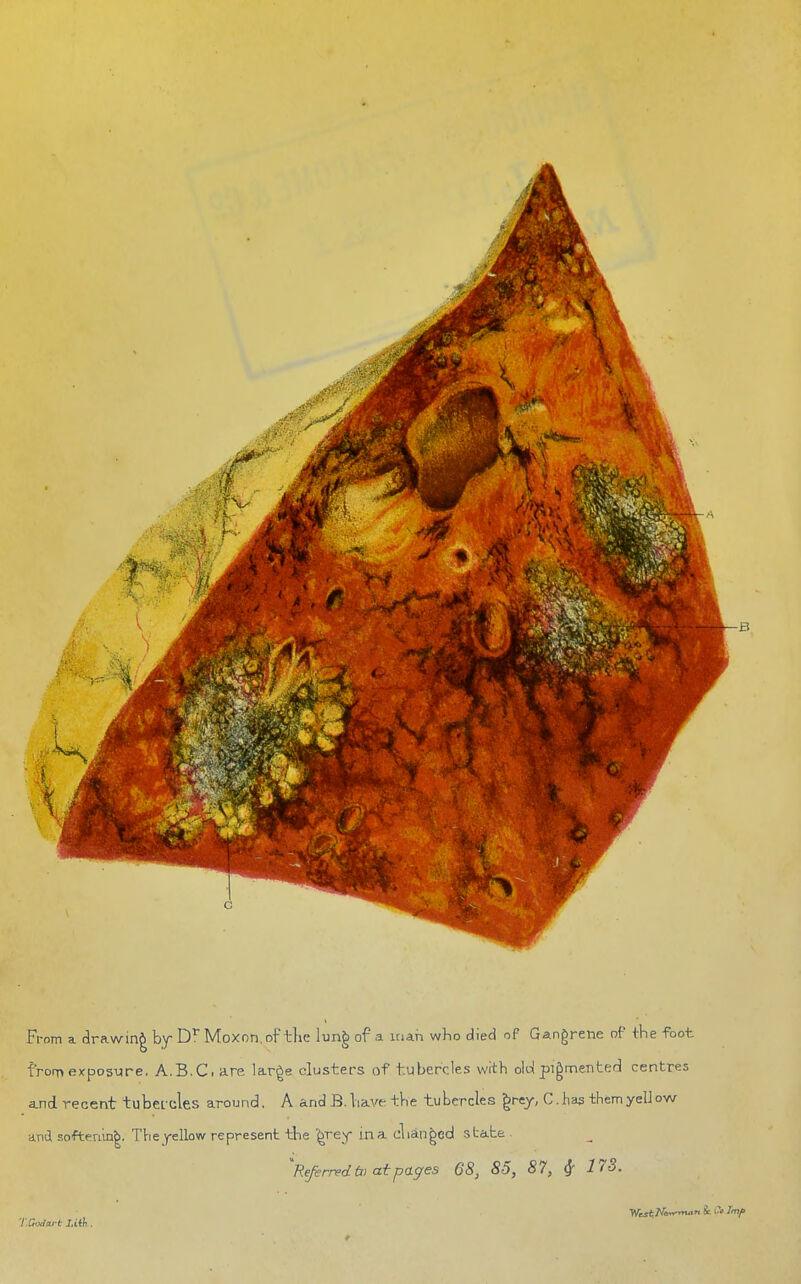 From a drawing by Dr Moxon, of tlie lung of a man who died of Gangrene of the foot from exposure. A.B.C. are lar^e clusters of tubercles with old pigmented centres and recent tubercles around. A and B. have the tubercles grey, C. has them yeU ow ■dx\i softening. Theyellow represent the ^rey ina changed state ^Referred tx> at pages 68, 85, 87, if 173.