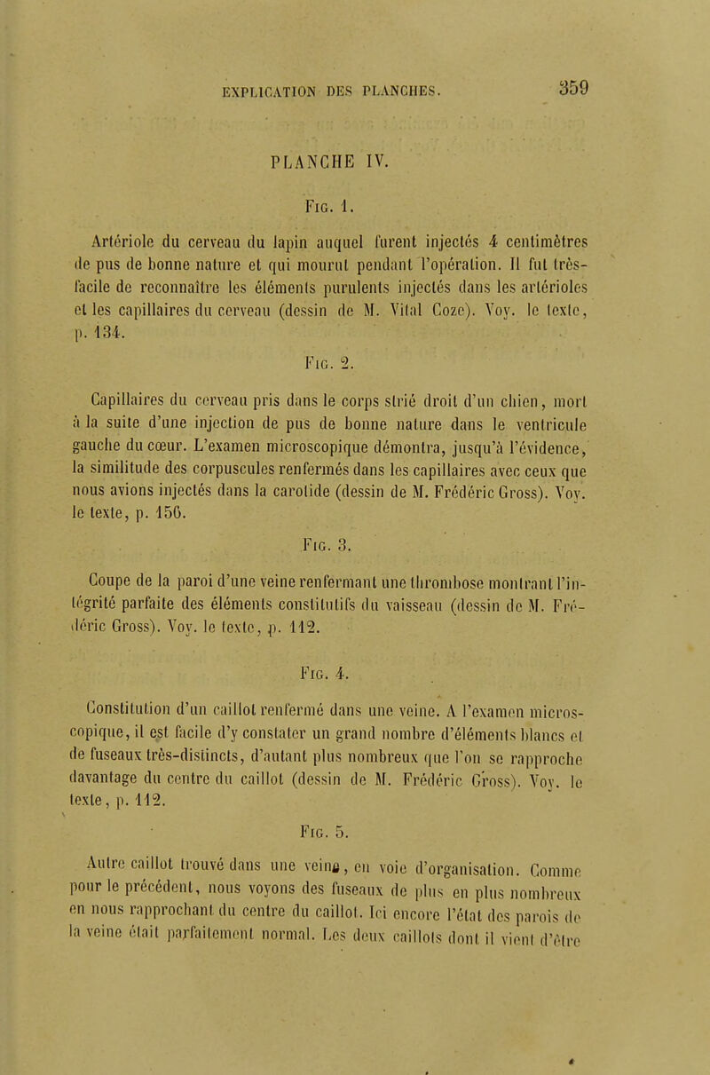 PLANCHE IV. FiG. 1. Artoriolft du cerveau du lapin auquel furent injectés 4 centimètres de pus de bonne nature et qui mourut pendant l'opération. Il fut très- facile de reconnaître les élémenis purulents injectés dans les arlérioles et les capillaires du cerveau (dessin de M. Vilal Gozo). Voy. le Icxie, p. 134. FiG. 2. Capillaires du cerveau pris dans le corps strié droit d'un chien, mort à la suite d'une injection de pus de bonne nature dans le ventricule gauche du cœur. L'examen microscopique démontra, jusqu'à l'évidence, la similitude des corpuscules renfermés dans les capillaires avec ceux que nous avions injectés dans la carotide (dessin de M. Frédéric Gross). Voy. le texte, p. 45G. FiG. 3. Coupe de la paroi d'une veine renfermant une thrombose monlranl l'in- tégrité parfaite des éléments constitutifs du vaisseau (dessin de M. Fré- déric Gross). Voy. le lexlc, p. 112. FiG. 4. Constitution d'un caillot renfermé dans une veine. A l'examon micros- copique, il est Ificile d'y constater un grand nombre d'éléments blancs et de fuseaux très-distincts, d'autant plus nombreux que l'on se rapproche davantage du centre du caillot (dessin de M. Frédéric Gross). Voy. le texte, p. 112. FiG. 5. Autre caillot trouvé dans une veina, en voie d'organisation. Comme pour le précédent, nous voyons des fuseaux de plus en plus nombreux en nous rapprochant du centre du caillot. Ici encore l'état des parois de la veine était parfaitement normal. Les deux caillols dont il vieni d'cMre *