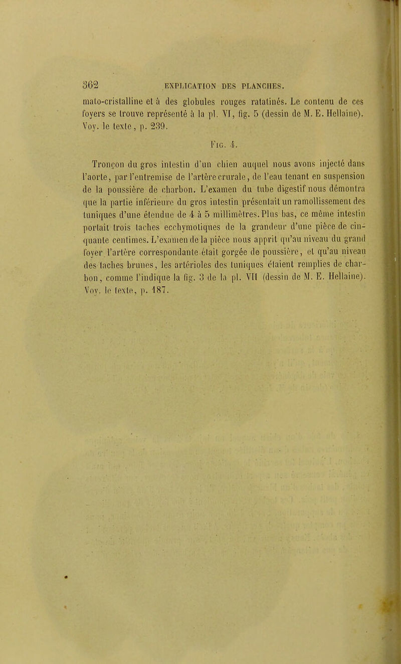 malo-crislallino cl à des globules rouges ratatinés. Le contenu de ces loyers se trouve représenté à la pl. YI, fig. 5 (dessin de M. E. Hellaine). Voy. le texte, p. 239. Fig. 4. Tronçon du gros intestin d'un chien au(|uel nous avons injecté dans l'aorte, par l'ontreniise de l'artère crurale, de l'eau tenant en suspension de la poussière de charbon. L'examen du tube digestif nous démontra que la partie inférieure du gros intestin présentait un ramollissement des tuniques d'une étendue de 4 à 5 millimètres.Plus bas, ce même intestin portait trois taches ecchymotiques de la grandeur d'une pièce de cin- quante centimes. L'examen de la pièce nous apprit qu'au niveau du grand foyer l'artère correspondante était gorgée de poussière, et qu'au niveau des taches brunes, les artérioles des tuniques étaient remplies do char- bon, comme l'indique la fig. 3 de la pl. VU (dessin de M. E. Hellaine). Voy. le lexte, p. 187.