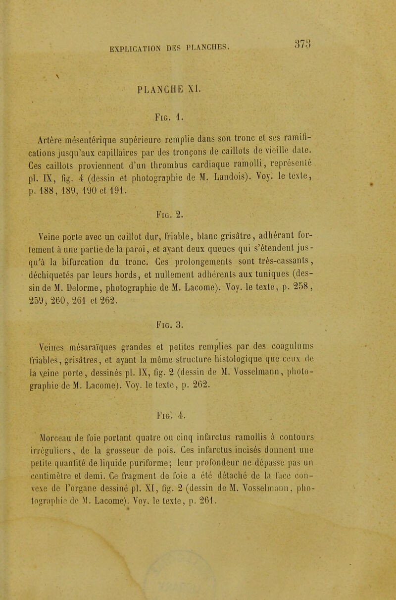 PLANCHE XI. FiG. 1. Artère méseiitérique supérieure remplie dans son tronc et ses ramifi- cations jusqu'aux capillaires par des tronçons de caillots de vieille date. Ces caillots proviennent d'un thrombus cardiaque ramolli, représenié pl. IX, fig. 4 (dessin et photographie de M. Landois). Voy. le texte, p. 188, 189, 190 et 191. FiG. 2. Veine porte avec un caillot dur, friable, blanc grisâtre, adhérant for- tement à une partie de la paroi, et ayant deux queues qui s'étendent jus- qu'à la bifurcation du tronc. Ces prolongements sont très-cassants, déchiquetés par leurs bords, et nullement adhérents aux tuniques (des- sin de M. Delorme, photographie de M. Lacome). Voy. le texte, p. 258, 259, 260, 261 et 262. FiG. 3. Veines mésaraïques grandes et petites remplies par des coagulums friables, grisâtres, et ayant la même structure histologique que ceux do lav.eine porte, dessinés pl. IX, fig. 2 (dessin de M. Vosselmann, piioto- graphie de M. Lacome). Voy. le texte, p. 262. Fig. 4. iMorceau de foie portant quatre ou cinq infarctus ramollis à contours irréguliers, de la grosseur de pois. Ces infarctus incisés donnent une petite quantité de liquide puriforme; leur profondeur ne dépasse pas un centimèlre et demi. Ce fragment de foie a été détaché de la face con- vexe de l'organe dessiné pl. XI, fig. 2 (dessin de M. Vosselmann, pho- lographii^ de M. Lacome). Voy. le texte, p. 261.