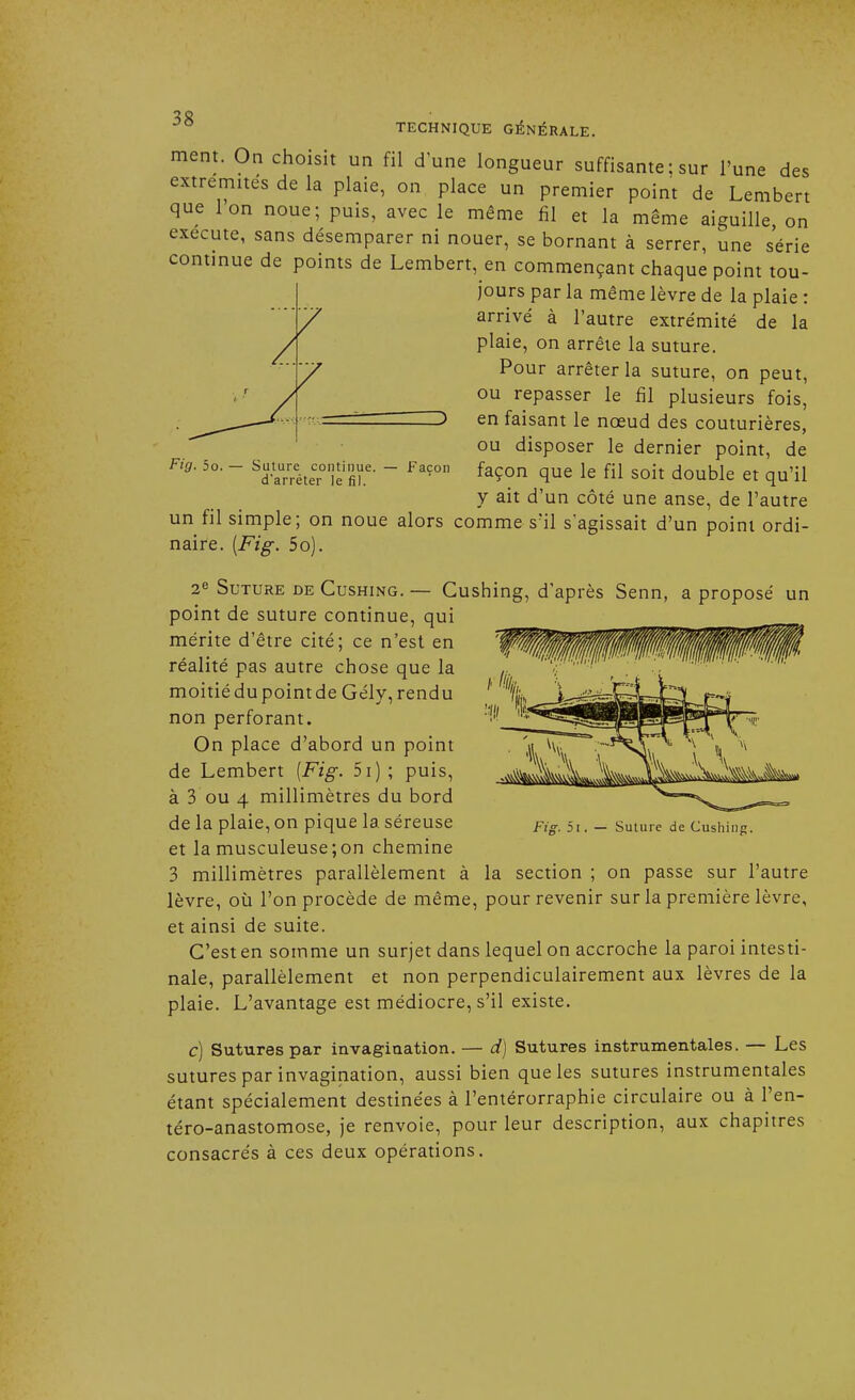 Fig. 5o. — Suture continue d'arrêter le fi). Façon 20 ° TECHNIQUE GÉNÉRALE. ment. On choisit un fil d'une longueur suffisante ; sur l'une des extrémités de la plaie, on place un premier point de Lembert que Ion noue; puis, avec le même fil et la même aiguille, on exécute, sans désemparer ni nouer, se bornant à serrer, une série continue de points de Lembert, en commençant chaque point tou- jours par la même lèvre de la plaie : arrivé à l'autre extrémité de la plaie, on arrête la suture. Pour arrêter la suture, on peut, ou repasser le fil plusieurs fois, en faisant le nœud des couturières, ou disposer le dernier point, de façon que le fil soit double et qu'il y ait d'un côté une anse, de l'autre un fil simple; on noue alors comme s'il s'agissait d'un point ordi- naire. [Fig. 5o). 2e Suture de Cushing. — Cushing, d'après Senn, a proposé un point de suture continue, qui mérite d'être cité; ce n'est en réalité pas autre chose que la moitiédupointde Gély, rendu non perforant. On place d'abord un point de Lembert [Fig. 5i) ; puis, à 3 ou 4 millimètres du bord de la plaie, on pique la. séreuse et la musculeuse;on chemine 3 millimètres parallèlement à la section ; on passe sur l'autre lèvre, où l'on procède de même, pour revenir sur la première lèvre, et ainsi de suite. C'est en somme un surjet dans lequel on accroche la paroi intesti- nale, parallèlement et non perpendiculairement aux lèvres de la plaie. L'avantage est médiocre, s'il existe. c) Sutures par invagination. — d) Sutures instrumentales. — Les sutures par invagination, aussi bien que les sutures instrumentales étant spécialement destinées à l'entérorraphie circulaire ou à l'en- téro-anastomose, je renvoie, pour leur description, aux chapitres consacrés à ces deux opérations. !»