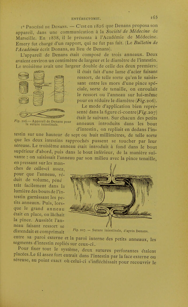 Fig. 206.— Appareil de Denans pour la suture intestinale. i° Procédé de Denans. — C'est en 1826 que Denans proposa son appareil, dans une communication à la Société de Médecine de Marseille. En 1838, il le présenta à l'Académie de Médecine. Emery fut chargé d'un rapport, qui ne fut pas fait. (Le Bulletin de VAcadémie écrit Donans, au lieu de Denans). L'appareil de Denans était composé de trois anneaux. Deux avaient environ un centimètre de largeur et le diamètre de l'intestin. Le troisième avait une largeur double de celle des deux premiers; il était fait d'une lame d'acier faisant ressort, de telle sorte qu'en le saisis- sant entre les mors d'une pince spé- ciale, sorte de tenaille, on enroulait le ressort ou l'anneau sur lui-même pour en réduire le diamètre (Fig.206). Le mode d'application bien repré- senté dans la figure ci-contre (Fig. 207) était le suivant. Sur chacun des petits anneaux introduits dans les bout d'intestin, on repliait en dedans l'in- testin sur une hauteur de sept ou huit millimètres, de telle sorte que les deux intestins rapprochés pussent se toucher par leur séreuse. Le troisième anneau était introduit à fond dans le bout supérieur d'abord, puis dans le bout inférieur, de la manière sui- vante : on saisissait l'anneau par son milieu avec la pince tenaille, en pressant sur les man- ches de celle-ci assez, pour que l'anneau, ré- duit de volume, péné trât facilement dans la lumière des bouts de l'in- testin garnissant les pe- tits anneaux. Puis, lors- que le grand anneau était en place, on lâchait la pince. Aussitôt l'an- neau faisant ressort se distendait et comprimait entre sa paroi externe et la paroi interne des petits anneaux, les segments d'intestin repliés sur ceux-ci. Pour fixer tout le système, deux sutures perforantes étaient placées. Le fil assez fort entrait dans l'intestin par la face externe ou séreuse, au point exact où celui-ci s'infléchissait pour recouvrir le Fig. 207. — Suture intestinale, d'après Denans.