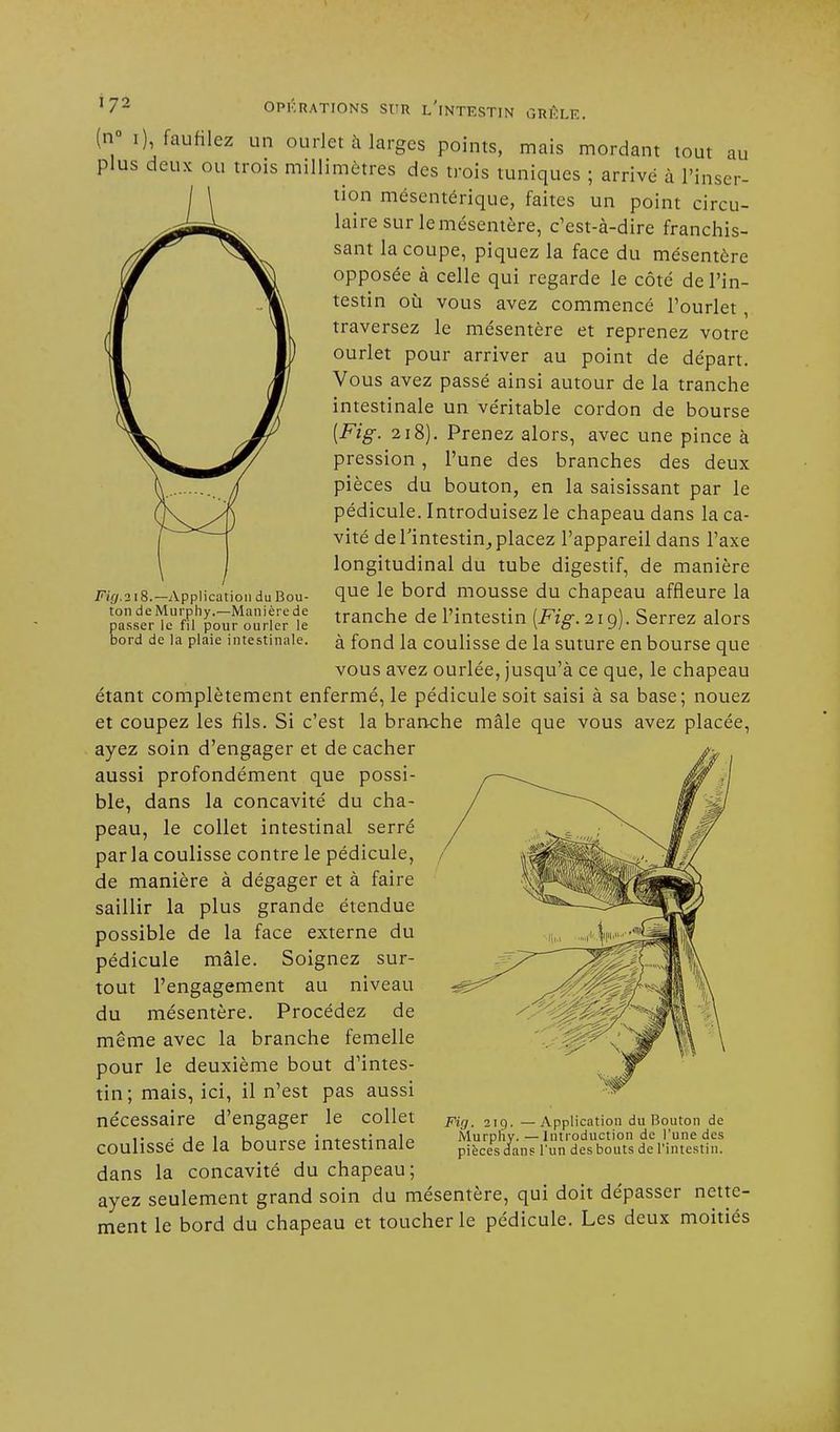 Fif/.2i8.— Application du Bou- ton de Murphy.—Manière de passer le fil pour ourler le bord de la plaie intestinale. J72 OPERATIONS SUR L'INTESTIN GRÊLE. (n° i), faufilez un ourlet à larges points, mais mordant tout au plus deux ou trois millimètres des trois tuniques ; arrive à l'inser- tion mésentérique, faites un point circu- laire sur le mésentère, c'est-à-dire franchis- sant la coupe, piquez la face du mésentère opposée à celle qui regarde le côté de l'in- testin où vous avez commencé l'ourlet , traversez le mésentère et reprenez votre ourlet pour arriver au point de départ. Vous avez passé ainsi autour de la tranche intestinale un véritable cordon de bourse [Fig. 218). Prenez alors, avec une pince à pression, l'une des branches des deux pièces du bouton, en la saisissant par le pédicule. Introduisez le chapeau dans la ca- vité de l'intestin, placez l'appareil dans l'axe longitudinal du tube digestif, de manière que le bord mousse du chapeau affleure la tranche de l'intestin (Fig. 21 g). Serrez alors à fond la coulisse de la suture en bourse que vous avez ourlée, jusqu'à ce que, le chapeau étant complètement enfermé, le pédicule soit saisi à sa base; nouez et coupez les fils. Si c'est la branche mâle que vous avez placée, ayez soin d'engager et de cacher aussi profondément que possi- ble, dans la concavité du cha- peau, le collet intestinal serré parla coulisse contre le pédicule, de manière à dégager et à faire saillir la plus grande étendue possible de la face externe du pédicule mâle. Soignez sur- tout l'engagement au niveau du mésentère. Procédez de même avec la branche femelle pour le deuxième bout d'intes- tin; mais, ici, il n'est pas aussi nécessaire d'engager le collet coulissé de la bourse intestinale dans la concavité du chapeau; ayez seulement grand soin du mésentère, qui doit dépasser nette- ment le bord du chapeau et toucher le pédicule. Les deux moitiés Fig. 219. —Application du Bouton de Murphy. — Introduction de l'une des pièces dans l'un des bouts de l'intestin.