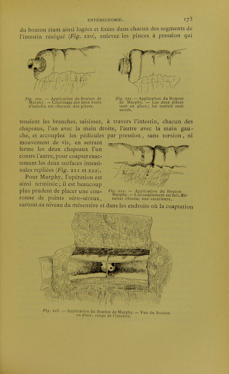 du bouton étant ainsi logées et fixées dans chacun des segments de l'intestin réséqué {Fig. 220), enlevez les pinces à pression qui Fig. 220. — Application du Bouton de Murphy . — Coulissage des deux bouts d'intestin sur chacune des pièces. Fig. 221.—Application du Bouton de Murphy. — Les deux pièces sont en place; les ourlets sont serre's. tenaient les branches, saisissez, à travers l'intestin, chacun des chapeaux, l'un avec la main droite, l'autre avec la main gau- che, et accouplez les pédicules par pression , sans torsion , ni mouvement de vis, en serrant ferme les deux chapeaux l'un contre l'autre, pour coapterexac- tement les deux surfaces intesti- nales repliées [Fig. 221 et 222). Pour Murphy, l'opération est ainsi terminée ; il est beaucoup plus prudent de placer Une COU- Fi9- 222- — Application du Bouton 1 . , , Murphy.—L'accouplement est fait.Re- roniie de points SerO-Sereux, sultat obtenu; vue extérieure. surtout au niveau du mésentère et dans les endroits où la coaptation Fig. 223. — Application du Bouton de Murphy.-Vue du Bouton en place; coupe de l'intestin.
