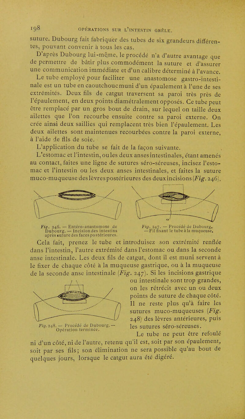 suture. Dubourg fait fabriquer des tubes de six grandeurs différen- tes, pouvant convenir à tous les cas. D'après Dubourg lui-même, le procédé n'a d'autre avantage que de permettre de bâtir plus commodément la suture et d'assurer une communication immédiate et d'un calibre déterminé à l'avance. Le tube employé pour faciliter une anastomose gastro-intesti- nale est un tube en caoutchouemuni d'un épaulement à l'une de ses extrémités. Deux fils de catgut traversent sa paroi très près de l'épaulement, en deux points diamétralement opposés. Ce tube peut être remplacé par un gros bout de drain, sur lequel on taille deux ailettes que l'on recourbe ensuite contre sa paroi externe. On crée ainsi deux saillies qui remplacent très bien l'épaulement. Les deux ailettes sont maintenues recourbées contre la paroi externe, à l'aide de fils de soie. L'application du tube se fait de la façon suivante. L'estomac et l'intestin, ouïes deux ansesintestinales, étant amenés au contact, faites une ligne de sutures séro-séreuses, incisez l'esto- mac et l'intestin ou les deux anses intestinales, et faites la suture muco-muqueuse des lèvres postérieures des deux incisions [Fig. 246). Fig. 246.—Entéro-anastomose de Dubourg. — Incision des intestins après suture des faces postérieures. tig.,247. — Filfix Procédé de Dubourg. xant le tube à la muqueuse. Cela fait, prenez le tube et introduisez son extrémité renflée dans l'intestin, l'autre extrémité dans l'estomac ou dans la seconde anse intestinale. Les deux fils de catgut, dont il est muni servent à le fixer de chaque côté à la muqueuse gastrique, ou à la muqueuse de la seconde anse intestinale [Fig. 247). Si les incisions gastrique I \ ou intestinale sont trop grandes, on les rétrécit avec un ou deux points de suture de chaque côté. Il ne reste plus qu'à faire les sutures muco-muqueuses [Fig. 248) des lèvres antérieures, puis les sutures séro-séreuses. Le tube ne peut être refoulé ni d'un côté, ni de l'autre, retenu qu'il est, soit par son épaulement, soit par ses fils; son élimination ne sera possible qu'au bout de quelques jours, lorsque le catgut aura été digéré. Fi;/. 248. — Procédé de Dubourg.— Opération terminée.
