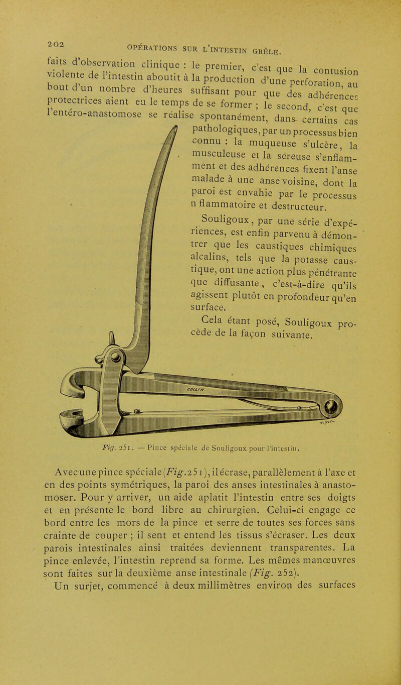 laits d'observation clinique : le premier c'est m,* u violente de l'intestin aboutit à la p'rodu'Son 7Z°P bout d'un nombre d'heures suffisant pour que d'es r nCe protectrices aient eu le temps de se former ; le second, c'e t que 1 entéro-anastomose se réalise spontanément, dans- certains cas pathologiques, par un processus bien connu: la muqueuse s'ulcère, la musculeuse et la séreuse s'enflam- ment et des adhérences fixent l'anse malade à une anse voisine, dont la paroi est envahie par le processus n flammatoire et destructeur. , Souligoux, par une série d'expé- riences, est enfin parvenu à démon- trer que les caustiques chimiques alcalins, tels que la potasse caus- tique, ont une action plus pénétrante que diffusante, c'est-à-dire qu'ils agissent plutôt en profondeur qu'en surface. Cela étant posé, Souligoux pro- cède de la façon suivante. Fig. 25 r. —Pince spéciale de Souligoux pour l'intcsiin. Avec une pince spéciale {Fig.251), il écrase, parallèlement à l'axe et en des points symétriques, la paroi des anses intestinales à anasto- moser. Pour y arriver, un aide aplatit l'intestin entre ses doigts et en présente le bord libre au chirurgien. Celui-ci engage ce bord entre les mors de la pince et serre de toutes ses forces sans crainte de couper ; il sent et entend les tissus s'écraser. Les deux parois intestinales ainsi traitées deviennent transparentes. La pince enlevée, l'intestin reprend sa forme. Les mêmes manœuvres sont faites sur la deuxième anse intestinale (Fig. 252). Un surjet, commencé à deux millimètres environ des surfaces