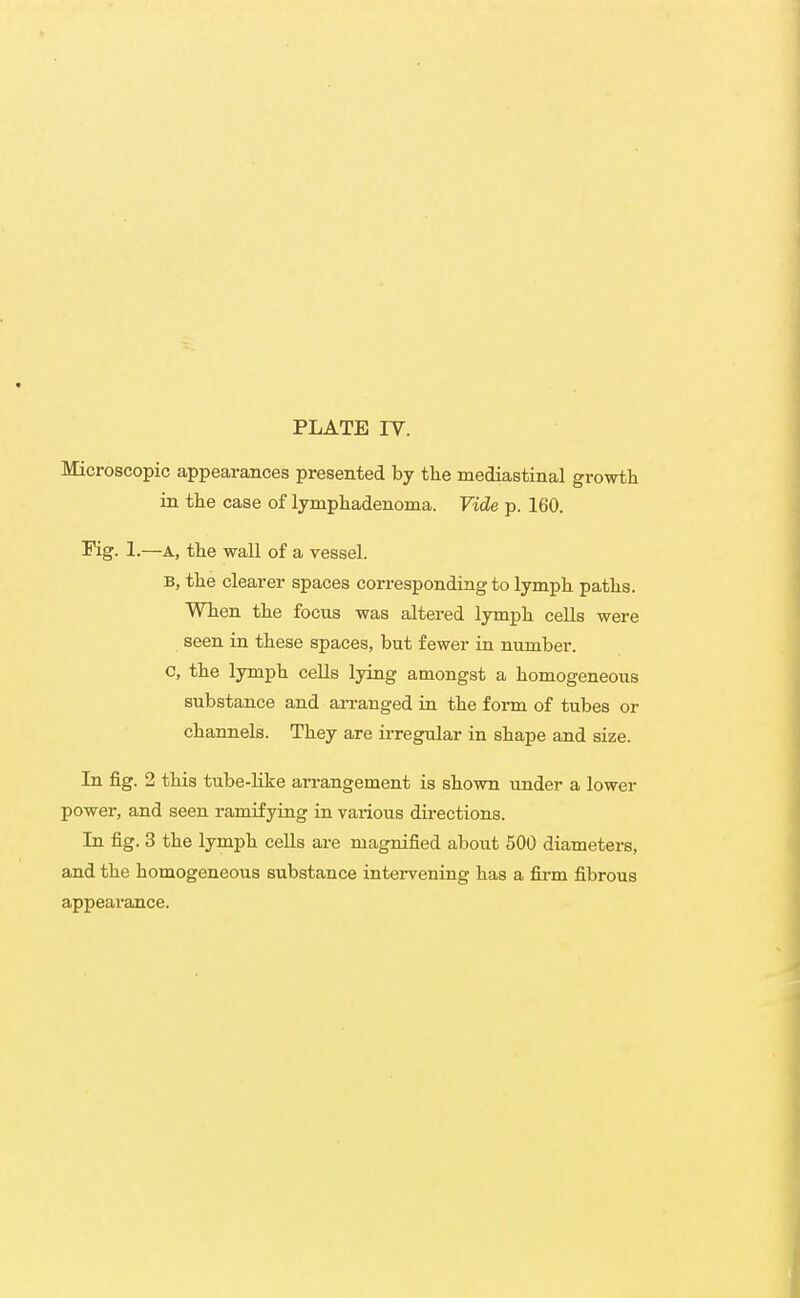 Microscopic appearances presented by the mediastinal growth in the case of lymphadenoma. Vide p. 160. rig. 1.—A, the wall of a vessel. B, the clearer spaces corresponding to lymph paths. When the focus was altered lymph cells were seen in these spaces, but fewer in number, c, the lymph cells lying amongst a homogeneous substance and arranged in the form of tubes or channels. They are irregular in shape and size. In fig. 2 this tube-Kke arrangement is shown under a lower power, and seen ramifyiug in various directions. In fig. 3 the lymph cells are magnified about 500 diameters, and the homogeneous substance intervening has a firm fibrous appeai'ance.