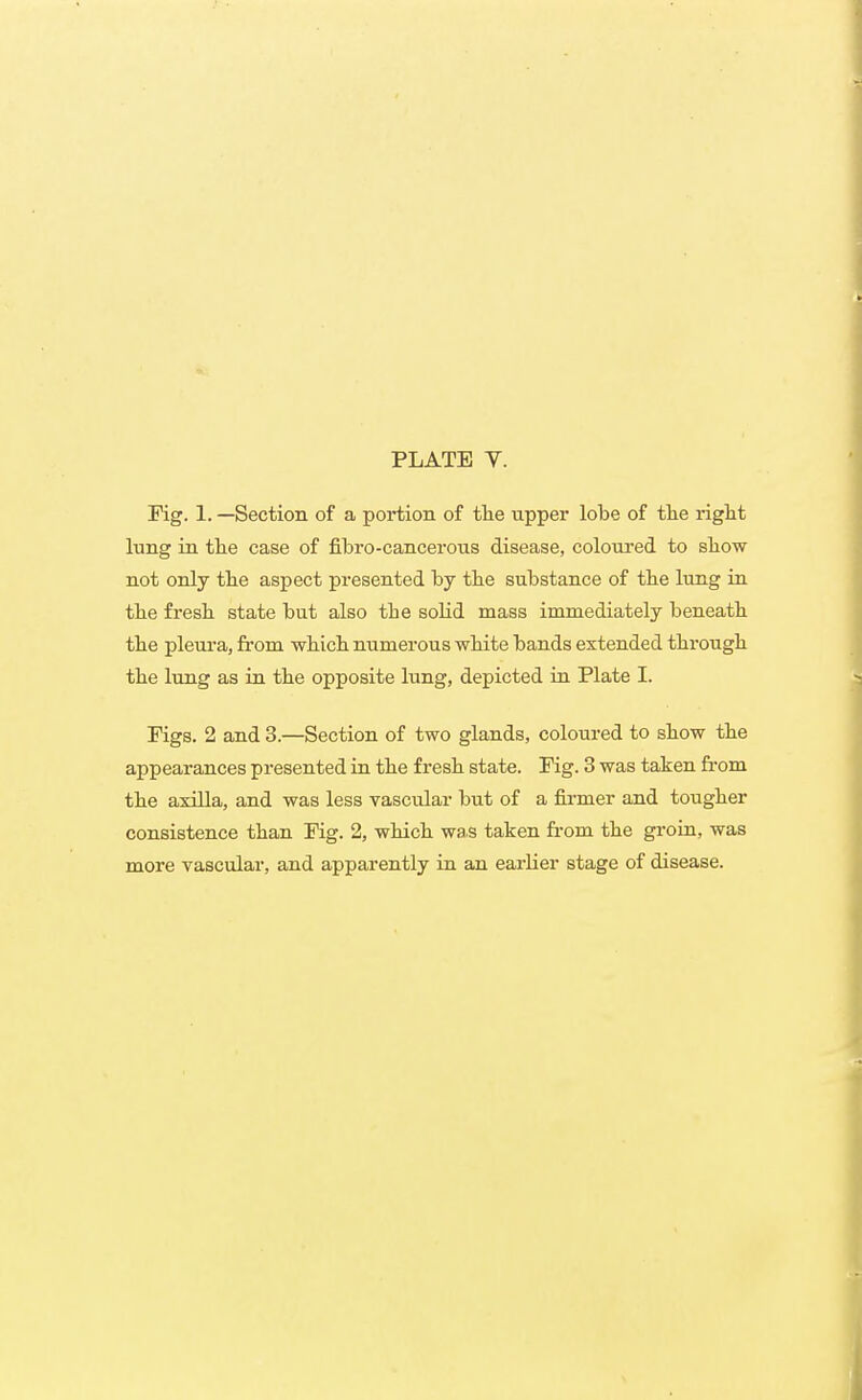 Fig. 1. —Section of a portion of tlie upper lobe of the right lung in tlie case of fibro-cancerous disease, coloured to show not only the aspect presented by the substance of the lung in the fresh state but also the solid mass immediately beneath the pleui'a, from which numerous white bands extended thi-ough the lung as in the opposite lung, depicted in Plate I. Figs. 2 and 3.—Section of two glands, coloured to show the appearances presented in the fresh state. Fig. 3 was taken fi-om the axilla, and was less vascular but of a firmer and tougher consistence than Fig. 2, which wa.s taken from the groin, was more vascular, and apparently in an earUer stage of disease.