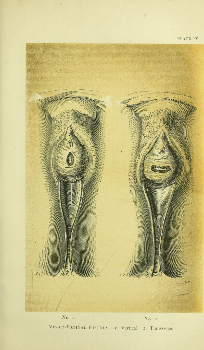 PLATE IX, No. i. No. 2 Vesico-Vaginal Fistula.—i-. Vertical. 2. Transv