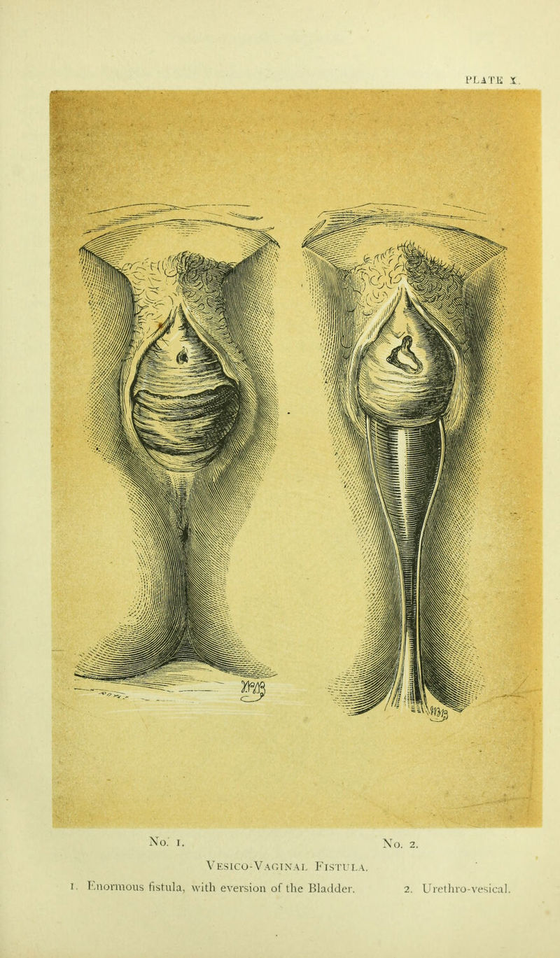 No.' i. No. 2. Vesicovaginal Fistula, i. Enormous fistula, with eversion of the Bladder. 2. Urethro-vesical.