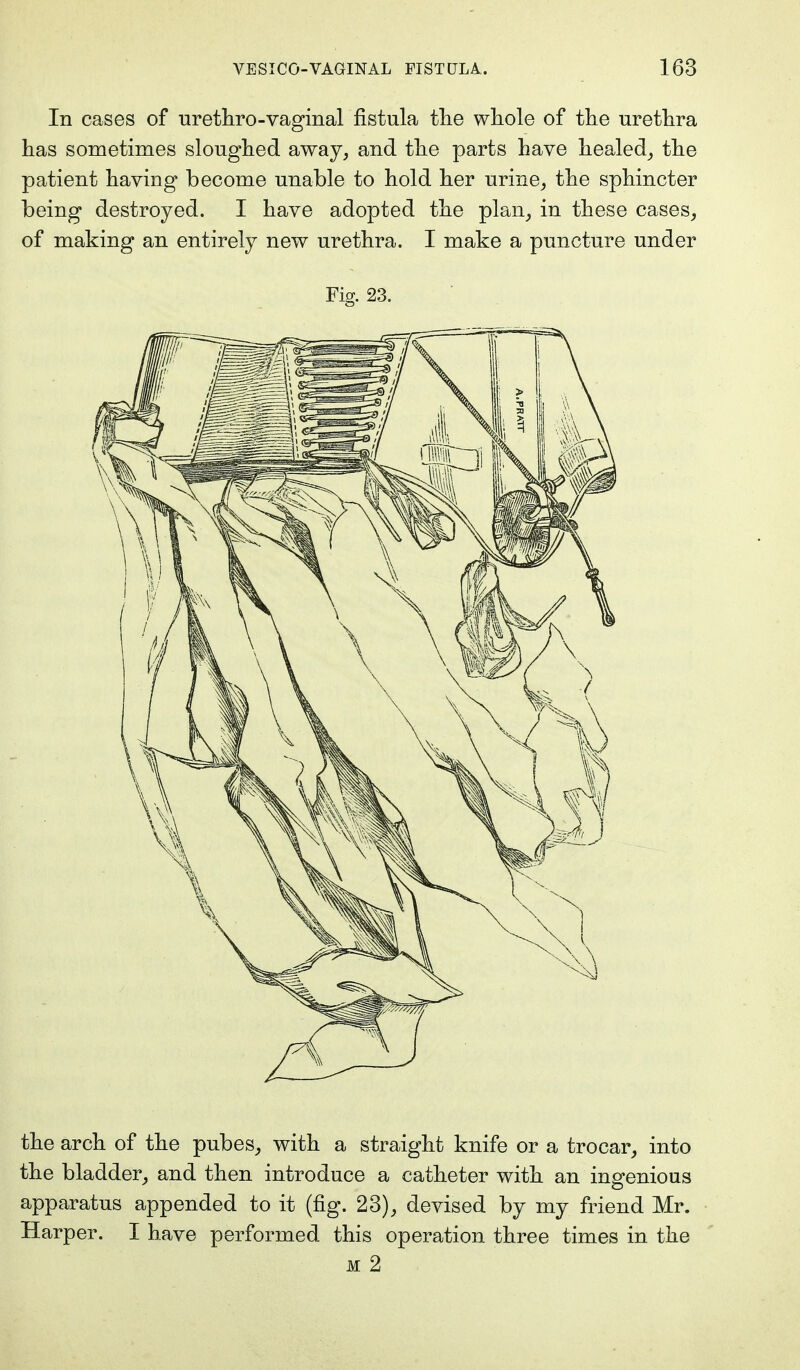 In cases of urethro-vaginal fistula the whole of the urethra has sometimes sloughed away, and the parts have healed, the patient having become unable to hold her urine, the sphincter being destroyed. I have adopted the plan, in these cases, of making an entirely new urethra. I make a puncture under Fig. 23. the arch of the pubes, with a straight knife or a trocar, into the bladder, and then introduce a catheter with an ingenious apparatus appended to it (fig. 23), devised by my friend Mr. Harper. I have performed this operation three times in the m 2