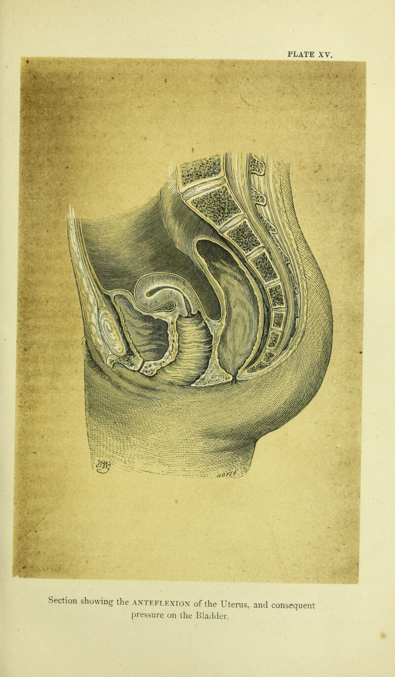 PLATE XV. Section showing the anteflexion of the Uterus, and consequent pressure on the Bladder.