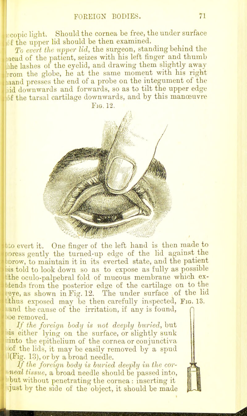 i-opic liglil. Should the cornea be free, the under surface .1: the upper Ud should be then examined. To evert the upper lid, the surgeon, standing behind the laead of the patient, seizes with his left finger and thumb hhe lashes of the eyelid, and drawing them slightly away prom the globe, he at the same moment with his right laand presses the end of a probe on the integument of the idd downwards and forwards, so as to tilt the upper edge if)f the tarsal cartilage downwards, and by this manoeuvre Fig.12. M evert it. One finger of the left hand is then made to iress gently the turned-up edge of the lid against the jrow, to maintain it in its everted state, and the patient IS told to look down so as to expose as fully as possible the oculo-palpebral fold of mucous membrane which ex- tends from the posterior edge of the cai'tilage on to the 3ye, as shown in Fig. 12. The under surface of the lid thus exposed may be then cai'efully inspected, Yia. 13. and the cause of the irritation, if any is found, je removed. If the foreign bodij is not daephj huried, but is either lying on the surface, or slightly sunk into the epithelium of the cornea or conjunctiva of the lids, it may be easily removed by a spud (Fig. 13), or by abroad needle. If the foreign body is huried d.eefly in the cor- 7i.eal t issue, a broad needle should be passed into, but without penetrating the cornea : inserting it just by the side of the object, it should be made