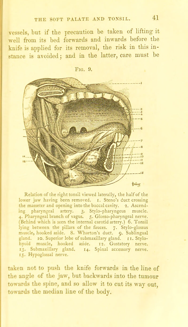 vessels, but if tlie precaution be taken of lifting- it well ti-om its bed forwards and inM'ards before tbe knife is applied for its removal, the risk in this in- stance is avoided; and in the latter, care must be Fig. 9. Relation of the right tonsil viewed laterally, the half of the lower jaw having been removed, i. Steno's duct crossing the masseter and opening into the buccal cavity. 2. Ascend- ing phar)'n2eal artery. 3. Stylo-pharyngeus muscle. 4. Pharyngeal branch of vagus. 5. Glosso-pharyngeal nerve. (Behind which is seen the internal carotid artery.) 6. Tonsil lying between the pillars of the fauces. 7. Stylo-glossus muscle, hooked aside. 8. Wharton's duct. 9. Sublingual gland. 10. Superior lobe of submaxillary gland. 11. Stylo- hyoid muscle, hooked aside. 12. Gustatory nei-ve. 13. Submaxillary gland. 14. Spinal accessory nerve. 15. Hypoglossal nerve. taken not to push the knife forwards in the line of the ang-le of the jaw, but backwards into the tumour towards the .s])ine, and so allow it to cut its way out, towards the median line of the body.