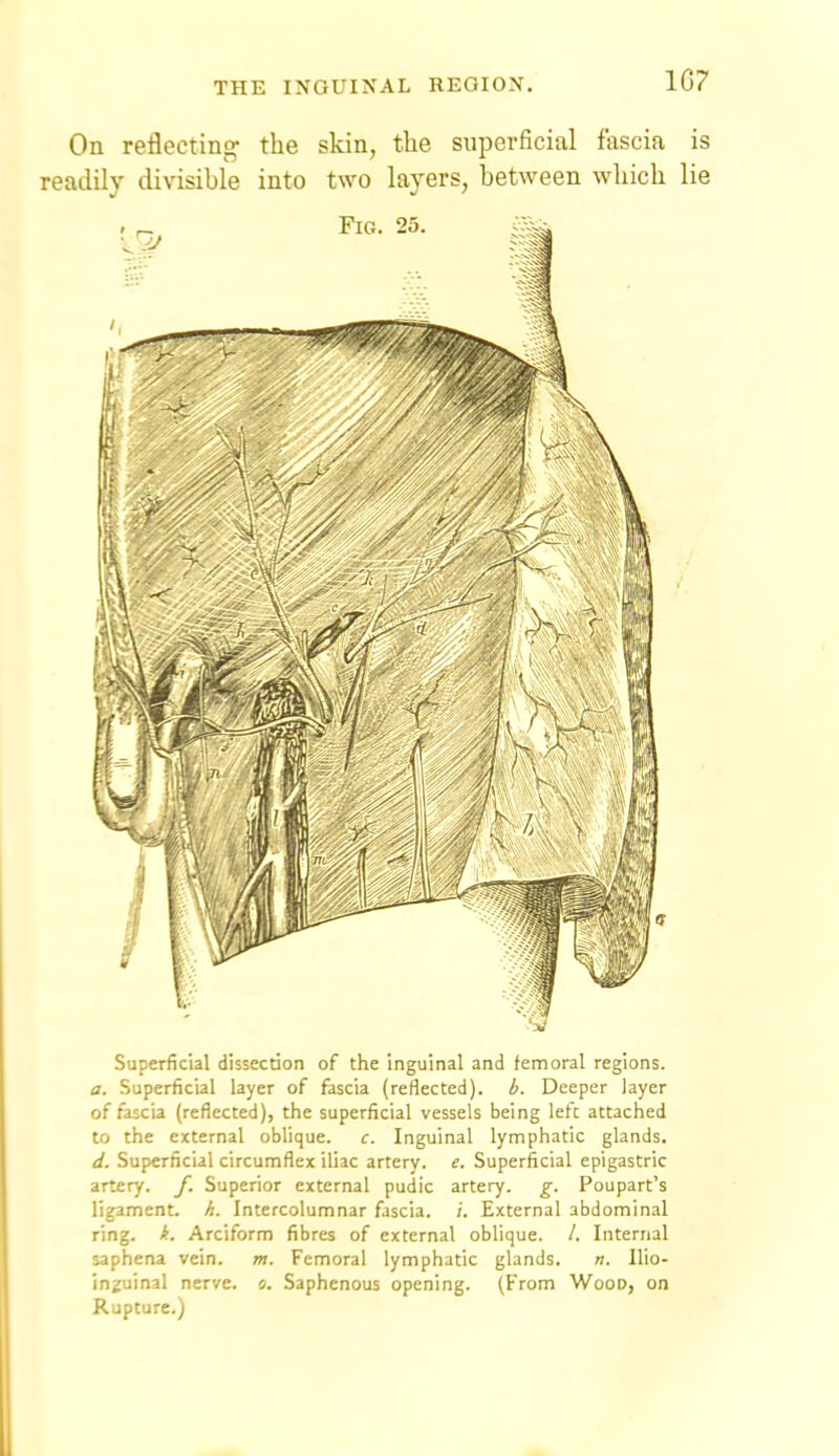 107 On reflecting- the skin, the superficial fascia is readily divisible into two layers, between which lie Superficial dissecdon of the inguinal and femoral regions. a. Superficial layer of fascia (reflected), i. Deeper layer of fascia (reflected), the superficial vessels being left attached to the external oblique, c. Inguinal lymphatic glands. d. Superficial circumflex iliac artery, e. Superficial epigastric artery, f. Superior external pudic artery, g. Poupart's ligament. A. Intercolumnar fascia, i. External abdominal ring. i. Arciform fibres of external oblique. /. Internal saphena vein. m. Femoral lymphatic glands. «. Ilio- injuinal nerve, o. Saphenous opening. (From Wood, on Rupture.)