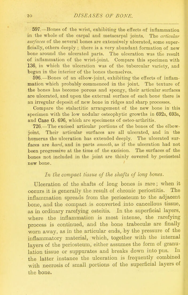 597.—Bones of the wrist, exhibiting the effects of inflammation in the whole of the carpal and metacarpal joints. The articular surfaces of the several bones are extensively ulcerated, some super- ficially, others deeply ; there is a very abundant formation of new bone around the ulcerated parts. The ulceration was the result of inflammation of the wrist-joint. Compare this specimen with 136, in which the ulceration was of the. tubercular variety, and began in the interior of the bones themselves. 596.—Bones of an elbow-joint, exhibiting the effects of inflam- mation which probably commenced in the joint. The texture of the bones has become porous and spongy, their articular surfaces are ulcerated, and upon the external surface of each bone there is an irregular deposit of new bone in ridges and sharp processes. Compare the stalactitic arrangement of the new bone in this specimen with the low nodular osteophytic growths in 692a, 693a, and Case Gr. 696, which are specimens of osteo-arthritis. 726.—The excised articular portions of the bones of the elbow- joint. Their articular surfaces are all ulcerated, and in the humerus the ulceration has extended deeply. The ulcerated sur- faces are hard, and in parts smooth, as if the ulceration had not been progressive at the time of the excision. The surfaces of the bones not included in the joint are thinly covered by periosteal new bone. In the compact tissue of the shafts of long holies. Ulceration of the shafts of long bones is rare; when it occurs it is generally the result of chronic periostitis. The inflammation spreads from the periosteum to the adjacent bone, and the compact is converted into cancellous tissue, as in ordinary rarefying osteitis. In the superficial layers, where the inflammation is most intense, the rarefying process is continued, and the bone trabeculse are finally worn away, as in the articular ends, by the pressure of the inflammatory material, which, together with the internal layers of the periosteum, either assumes the form of granu- lation tissue or suppurates and breaks down into pus. In the latter instance the ulceration is frequently combined ■with necrosis of small portions of the superficial layers of the bone.