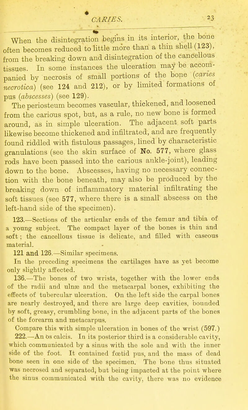 « CARIES. 23 When the disintegration begins in its interior, the bone often becomes reduced to little m6re than a thm shell (123), from the breaking down and disintegration of the cancellous tissues. In some instances the ulceration may be accom- panied by necrosis of small portions of the bone {cams necrotica) (see 124 and 212), or by limited formations of pus (abscesses) (see 129). The periosteum becomes vascular, thickened, and loosened from the carious spot, but, as a rule, no new bone is formed around, as in simple ulceration. The adjacent soft parts likewise become thickened and infiltrated, and are frequently found riddled with fistulous passages, lined by characteristic granulations (see the skin surface of No. 577, where glass rods have been passed into the carious ankle-joint), leading down to the bone. Abscesses, having no necessary connec- tion with the bone beneath, may also be produced by the breaking down of inflammatory material infiltrating the soft tissues (see 577, where there is a small abscess on the left-hand side of the specimen). 123.—Sections of the articular ends of the femur and tibia of a young subject. The compact layer of the bones is thin and soft; the cancellous tissue is delicate, and filled with caseous material. 121 and 126.—Similar specimens. In the preceding specimens the cartilages have as yet become only slightly aifected. 136.—The bones of two wrists, together with the lower ends of the radii and ulnae and the metacarpal bones, exhibiting the effects of tubercular ulceration. On the left side the carpal bones are nearly destroyed, and there are large deep cavities, bounded by soft, greasy, crumbling bone, in the adjacent parts of the bones of the forearm and metacarpus. Compare this with simple ulceration in bones of the wrist (597.) 222.—An OS calcis. In its posterior third is a considerable cavity, which communicated by a sinus with the sole and with the inner side of the foot. It contained foetid pus, and the mass of dead bone seen in one side of the specimen. The bone thus situated was necrosed and separated, but being impacted at the point where the sinus communicated with the cavity, there was no evidence