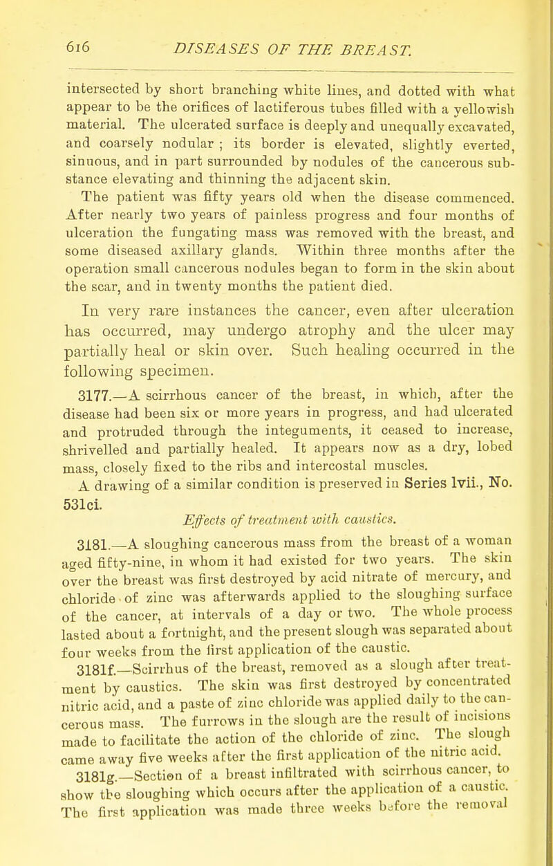 intersected by short branching white lines, and dotted with what appear to be the orifices of lactiferous tubes filled with a yellowish material. The ulcerated surface is deeply and unequally excavated, and coarsely nodular ; its border is elevated, slightly everted, sinuous, and in part surrounded by nodules of the cancerous sub- stance elevating and thinning the adjacent skin. The patient was fifty years old when the disease commenced. After nearly two years of painless progress and four months of ulceration the f ungating mass was removed with the breast, and some diseased axillary glands. Within three months after the operation small cancerous nodules began to form in the skin about the scar, and in twenty months the patient died. In very rare instances the cancer, even after ulceration has occurred, may undergo atrophy and the ulcer may partially heal or skin over. Such healing occurred in the following specimen. 3177.—A scirrhous cancer of the breast, in which, after the disease had been six or more years in progress, and had ulcerated and protruded through the integuments, it ceased to increase, shrivelled and partially healed. It appears now as a dry, lobed mass, closely fixed to the ribs and intercostal muscles. A drawing of a similar condition is preserved in Series Ivii., No. 531ci. Effects of treatment loith caustics. 3X81. A sloughing cancerous mass from the breast of a woman aged fifty-nine, in whom it had existed for two years. The skin over the breast was first destroyed by acid nitrate of mercury, and chloride • of zinc was afterwards applied to the sloughing surface of the cancer, at intervals of a day or two. The whole process lasted about a fortnight, and the present slough was separated about four weeks from the first application of the caustic. 3181f.—Scirrhus of the breast, removed as a slough after treat- ment by caustics. The skin was first destroyed by concentrated nitric acid, and a paste of zinc chloride was applied daily to the can- cerous mass. The furrows in the slough are the result of incisions made to facilitate the action of the chloride of zinc. The slough came away five weeks after the first application of the nitric acid. 3181g —Section of a breast infiltrated with scirrhous cancer, to show the sloughing which occurs after the application of a caustic The first application was made three weeks before the removal