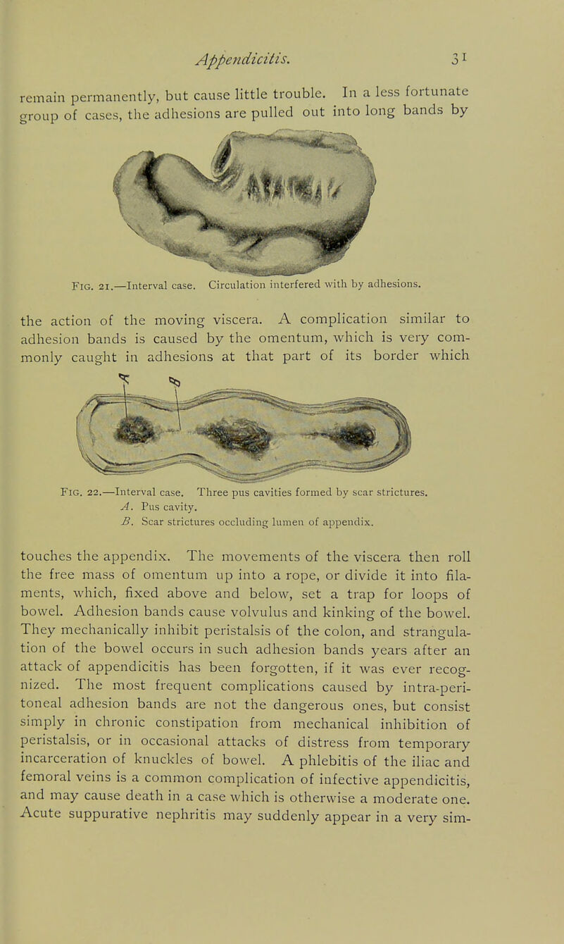 remain permanently, but cause little trouble. In a less fortunate group of cases, the adhesions are pulled out into long bands by Fig. 21.—Interval case. Circulation interfered with by adhesions. the action of the moving viscera. A complication similar to adhesion bands is caused by the omentum, which is very com- monly caught in adhesions at that part of its border which Fig. 22.—Interval case. Three pus cavities formed by scar strictures. A. Pus cavity. B. Scar strictures occluding lumen of appendix. touches the appendix. The movements of the viscera then roll the free mass of omentum up into a rope, or divide it into fila- ments, which, fixed above and below, set a trap for loops of bowel. Adhesion bands cause volvulus and kinking of the bowel. They mechanically inhibit peristalsis of the colon, and strangula- tion of the bowel occurs in such adhesion bands years after an attack of appendicitis has been forgotten, if it was ever recog- nized. The most frequent complications caused by intra-peri- toneal adhesion bands are not the dangerous ones, but consist simply in chronic constipation from mechanical inhibition of peristalsis, or in occasional attacks of distress from temporary incarceration of knuckles of bowel. A phlebitis of the iliac and femoral veins is a common complication of infective appendicitis, and may cause death in a case which is otherwise a moderate one. Acute suppurative nephritis may suddenly appear in a very sim-