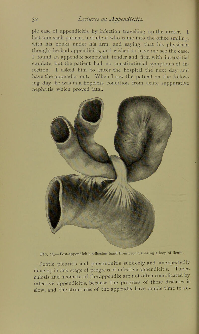 pie case of appendicitis by infection travelling up the ureter. I lost one such patient, a student who came into the office smiling, with his books under his arm, and saying that his physician thought he had appendicitis, and wished to have me see the case. I found an appendix somewhat tender and firm with interstitial exudate, but the patient had no constitutional symptoms of in- fection. I asked him to enter the hospital the next day and have the appendix out. When I saw the patient on the follow- ing day, he was in a hopeless condition from acute suppurative nephritis, which proved fatal. Fig. 23.—Post-appendicitis adhesion band from cecum snaring a loop of ileum. Septic pleuritis and pneumonitis suddenly and unexpectedly develop in any stage of progress of infective appendicitis. Tuber- culosis and neomata of the appendix are not often complicated by infective appendicitis, because the progress of these diseases is slow, and the structures of the appendix have ample time to ad-