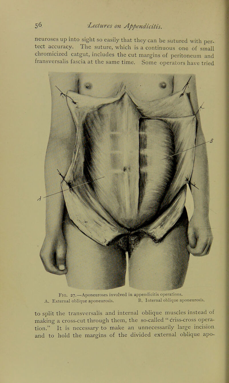 neuroses up into sight so easily that they can be sutured with per- tect accuracy. The suture, which is a continuous one of small chromicized catgut, includes the cut margins of peritoneum and fransversalis fascia at the same time. Some operators have tried Fig. 27.—Aponeuroses involved in appendicitis operations. A. External oblique aponeurosis. B. Internal oblique aponeurosis. to Split the transversalis and internal oblique muscles instead of making a cross-cut through them, the so-called  criss-cross opera- tion. It is necessary to make an unnecessarily large incision and to hold the margins of the divided external oblique apo-