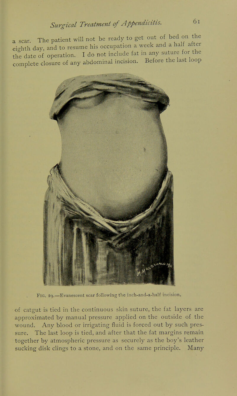 a scar. The patient will not be ready to get out of bed on the ei-hth day, and to resume his occupation a week and a half alter the date of operation. I do not include fat in any suture for the complete closure of any abdominal incision. Before the last loop Fig. 29.—Evanescent scar following tlie inch-and-a-lialf incision. of catgut is tied in the continuous skin suture, the fat layers are approximated by manual pressure applied on the outside of the wound. Any blood or irrigating fluid is forced out by such pres- sure. The last loop is tied, and after that the fat margins remain together by atmospheric pressure as securely as the boy's leather sucking disk clings to a stone, and on the same principle. Many