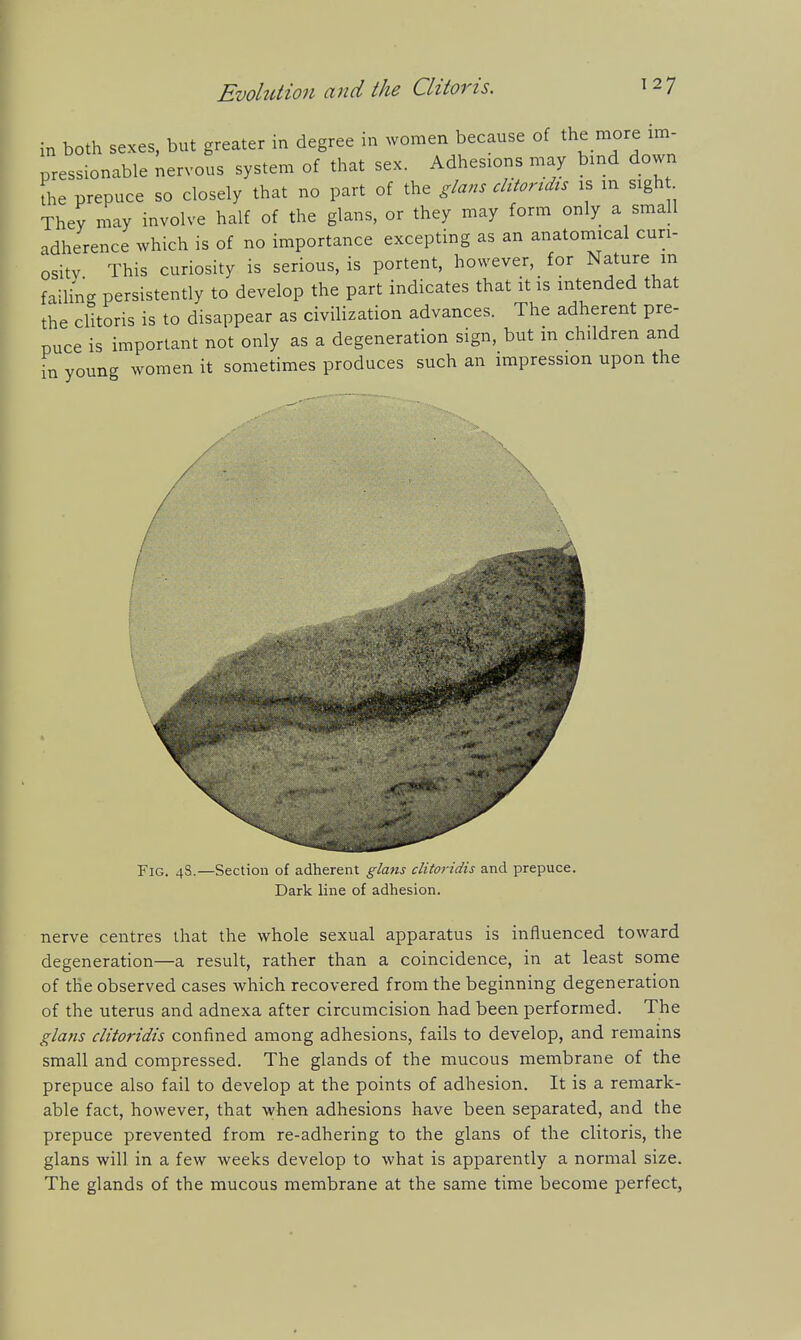 in both sexes, but greater in degree in women because of the more im- pressionable nervous system of that sex. Adhesions may bind down L prepuce so closely that no part of the glans chtortdis is in sigh They may involve half of the glans, or they may form only a small adherence which is of no importance excepting as an anatomical cun- ositv This curiosity is serious, is portent, however, for Nature in failing persistently to develop the part indicates that it is intended that the clitoris is to disappear as civilization advances. The adherent pre- puce is important not only as a degeneration sign, but in children and in young women it sometimes produces such an impression upon the Fig. 4S.—Section of adherent glans clitoridis and prepuce. Dark line of adhesion. nerve centres that the whole sexual apparatus is influenced toward degeneration—a result, rather than a coincidence, in at least some of the observed cases which recovered from the beginning degeneration of the uterus and adnexa after circumcision had been performed. The gla}is clitoridis confined among adhesions, fails to develop, and remains small and compressed. The glands of the mucous membrane of the prepuce also fail to develop at the points of adhesion. It is a remark- able fact, however, that when adhesions have been separated, and the prepuce prevented from re-adhering to the glans of the clitoris, the glans will in a few weeks develop to what is apparently a normal size. The glands of the mucous membrane at the same time become perfect,