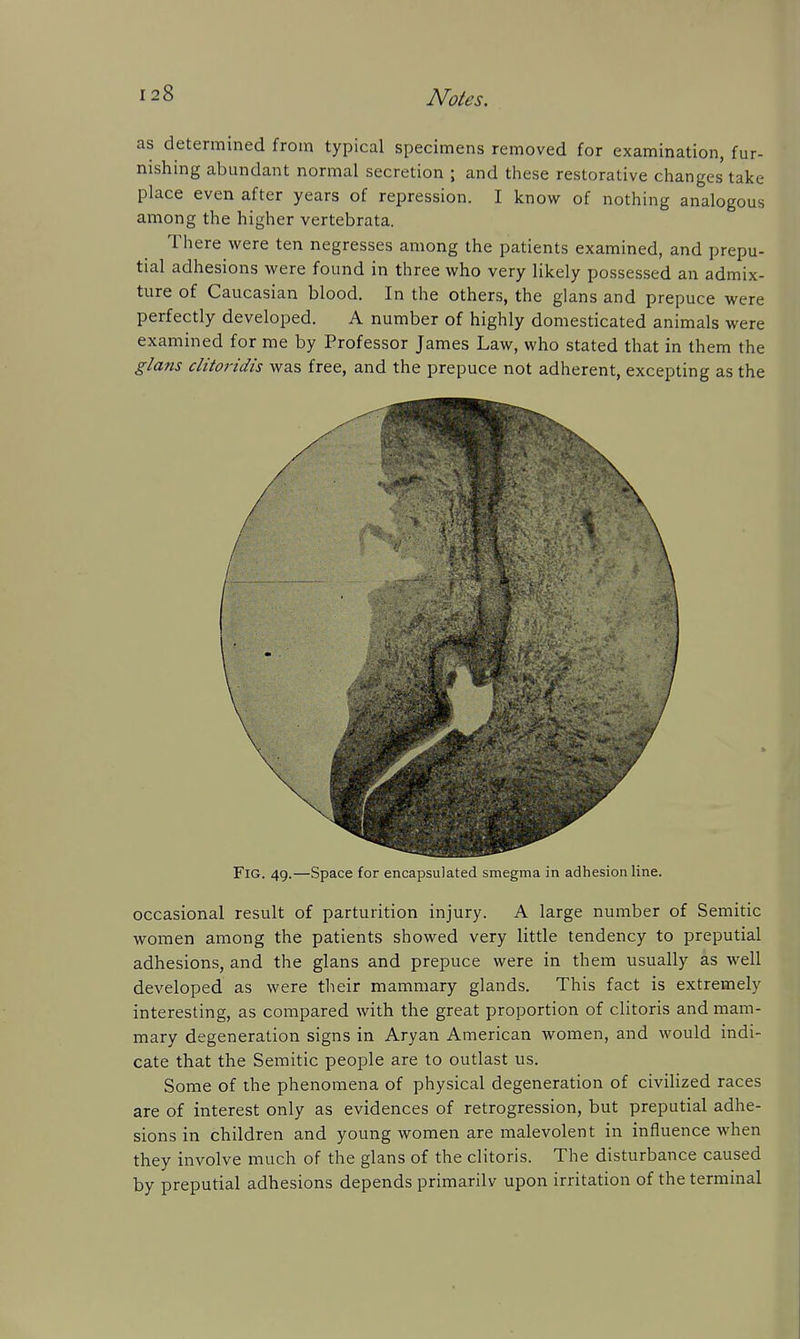 as determined from typical specimens removed for examination, fur- nishing abundant normal secretion ; and these restorative changes take place even after years of repression. I know of nothing analogous among the higher vertebrata. There were ten negresses among the patients examined, and prepu- tial adhesions were found in three who very likely possessed an admix- ture of Caucasian blood. In the others, the glans and prepuce were perfectly developed. A number of highly domesticated animals were examined for me by Professor James Law, who stated that in them the glans clitoridis was free, and the prepuce not adherent, excepting as the Fig. 49.—Space for encapsulated smegma in adhesion line. occasional result of parturition injury. A large number of Semitic women among the patients showed very little tendency to preputial adhesions, and the glans and prepuce were in them usually as well developed as were their mammary glands. This fact is extremely interesting, as compared with the great proportion of clitoris and mam- mary degeneration signs in Aryan American women, and would indi- cate that the Semitic people are to outlast us. Some of the phenomena of physical degeneration of civilized races are of interest only as evidences of retrogression, but preputial adhe- sions in children and young women are malevolent in influence when they involve much of the glans of the clitoris. The disturbance caused by preputial adhesions depends primarilv upon irritation of the terminal